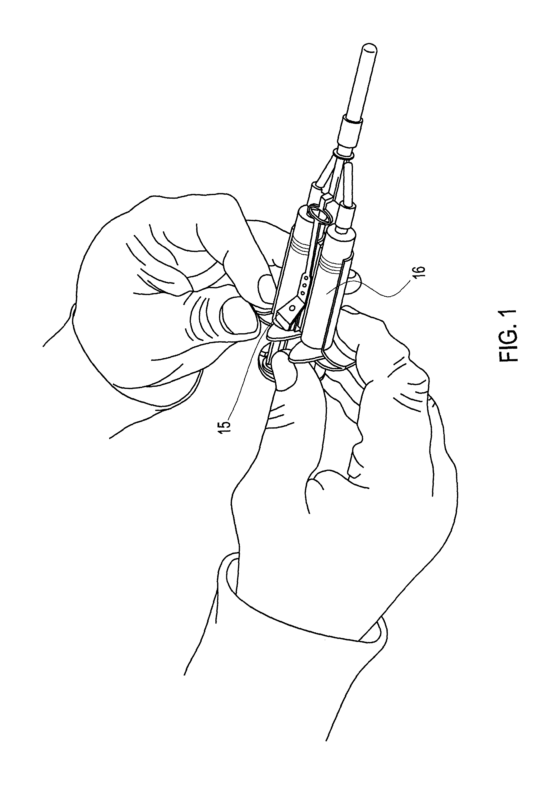 Method of arthroscopic osteochondral resurfacing using PRP strengthened with fibrin glue