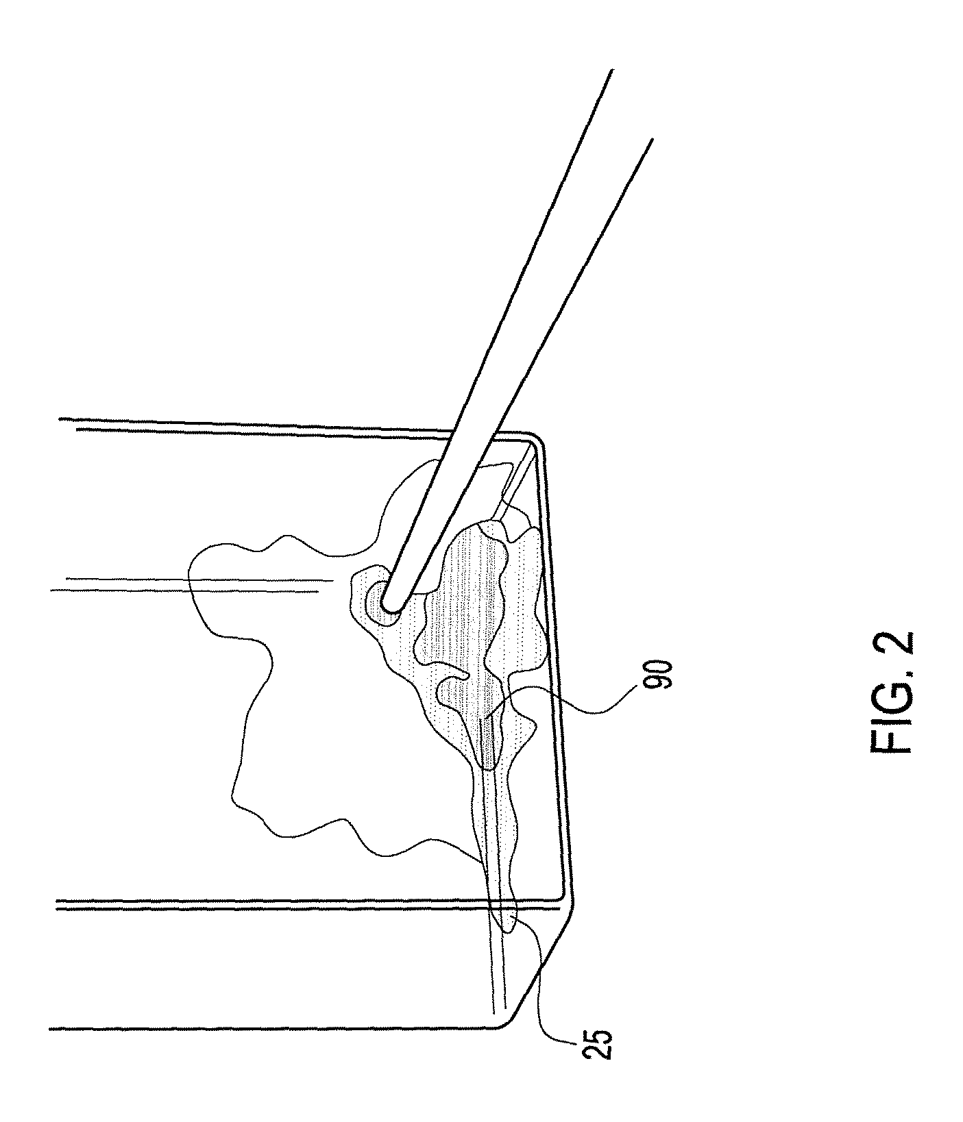 Method of arthroscopic osteochondral resurfacing using PRP strengthened with fibrin glue