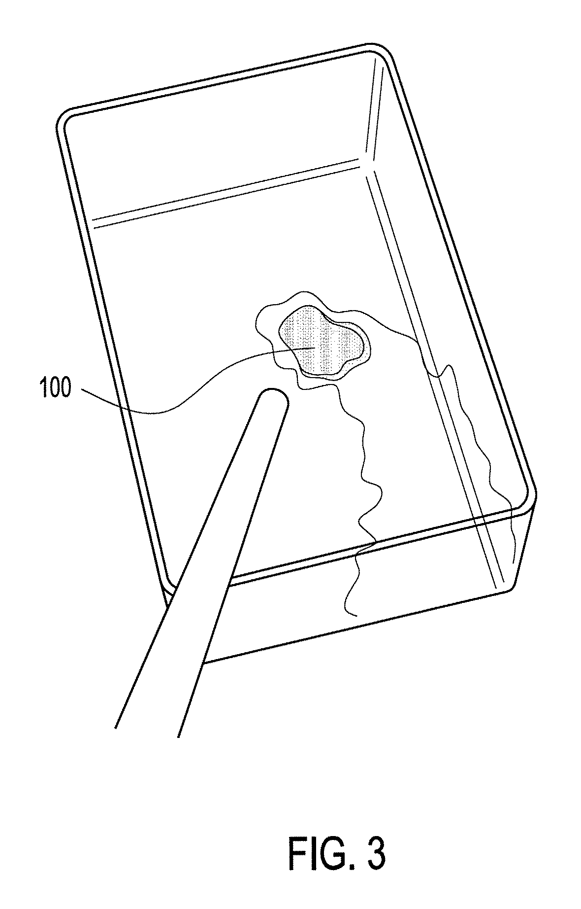 Method of arthroscopic osteochondral resurfacing using PRP strengthened with fibrin glue