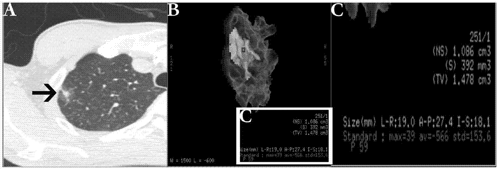 Establishing method of preoperative prediction model for lung cancer cell KI-67 expression index