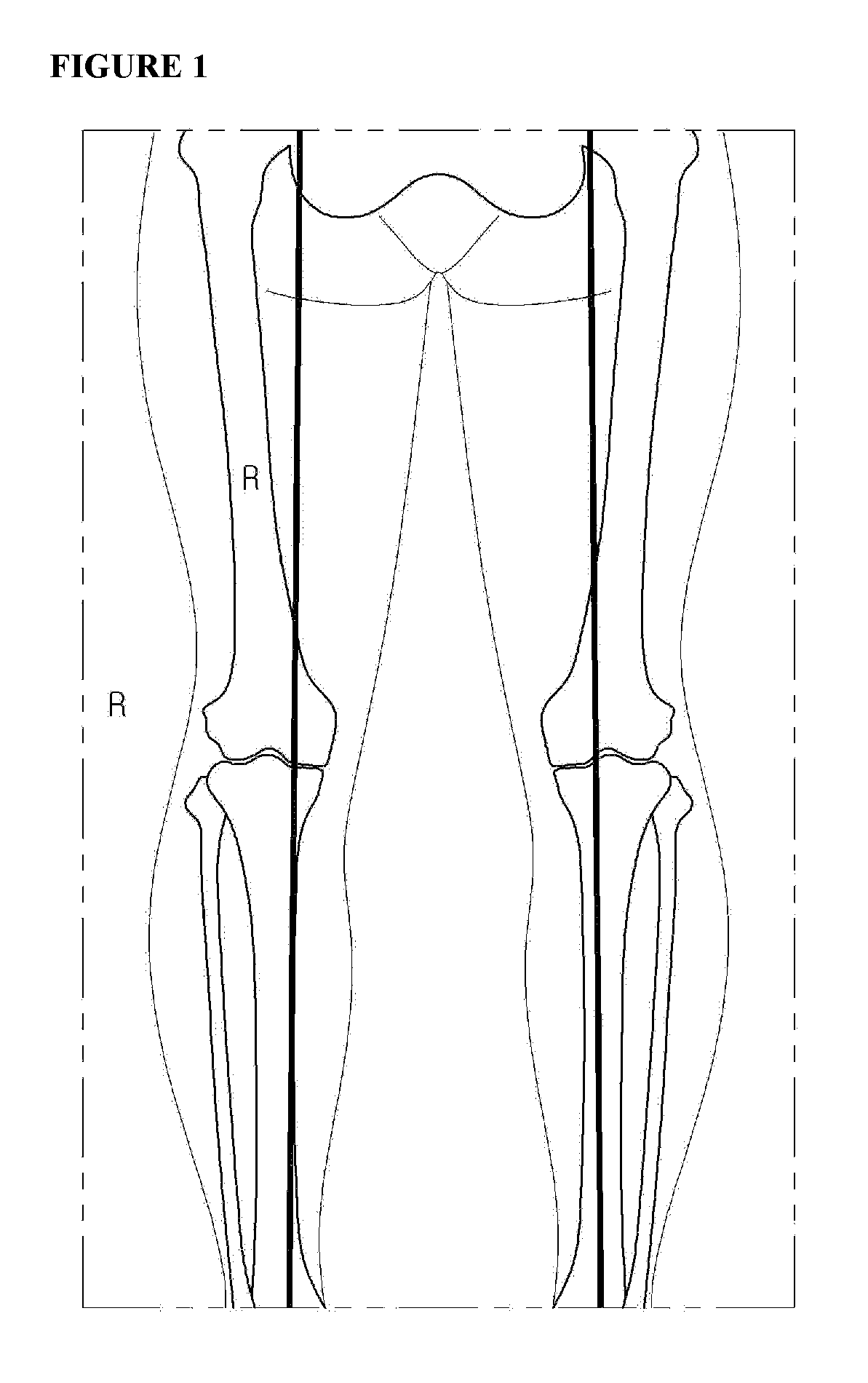 Fixing tool for open-wedge high tibial osteotomy