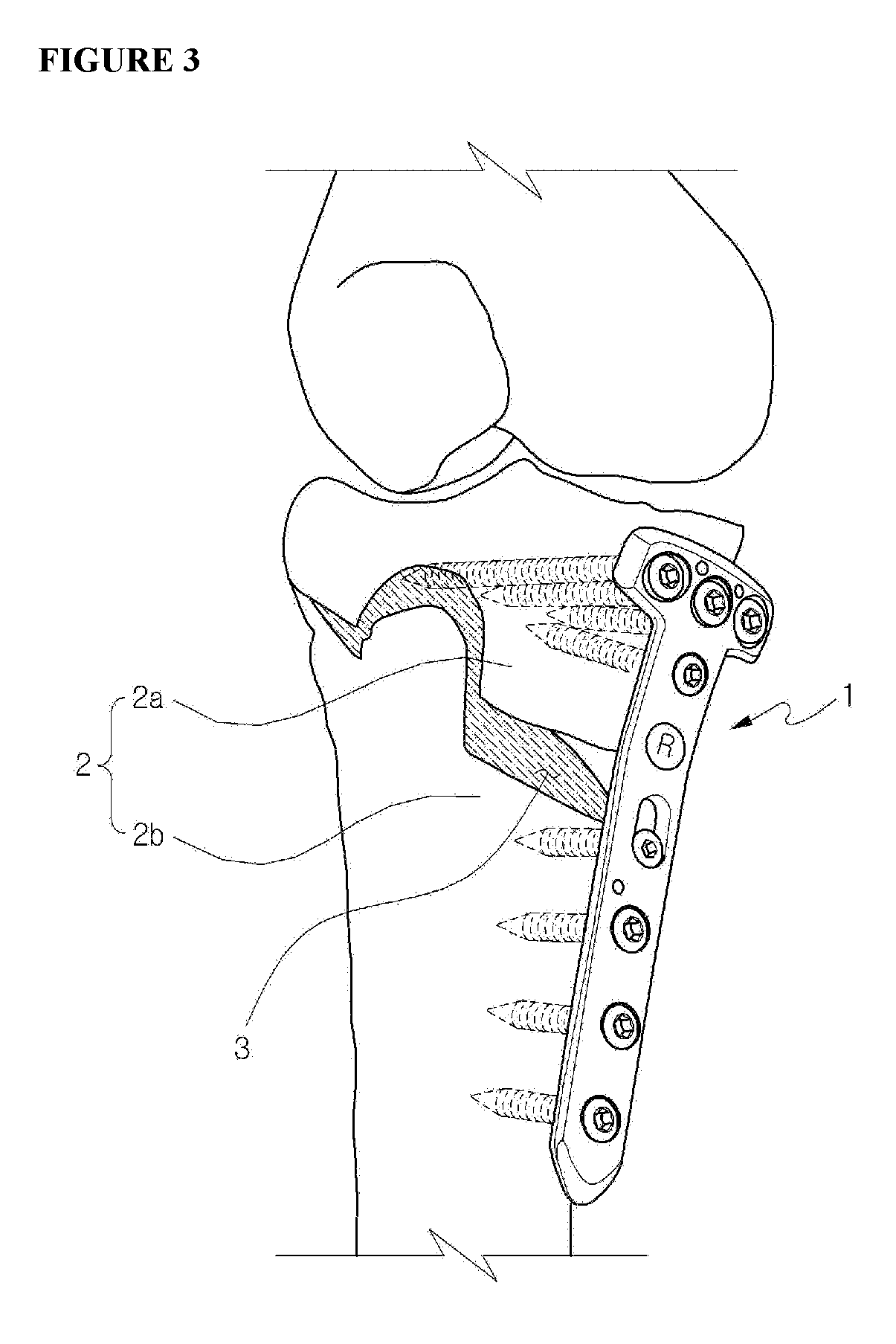 Fixing tool for open-wedge high tibial osteotomy