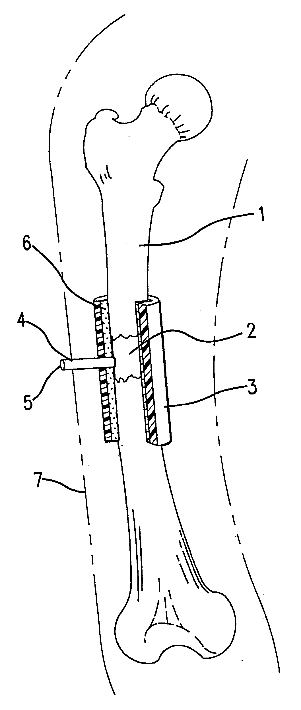 Bone regeneration device for bones, and method of use