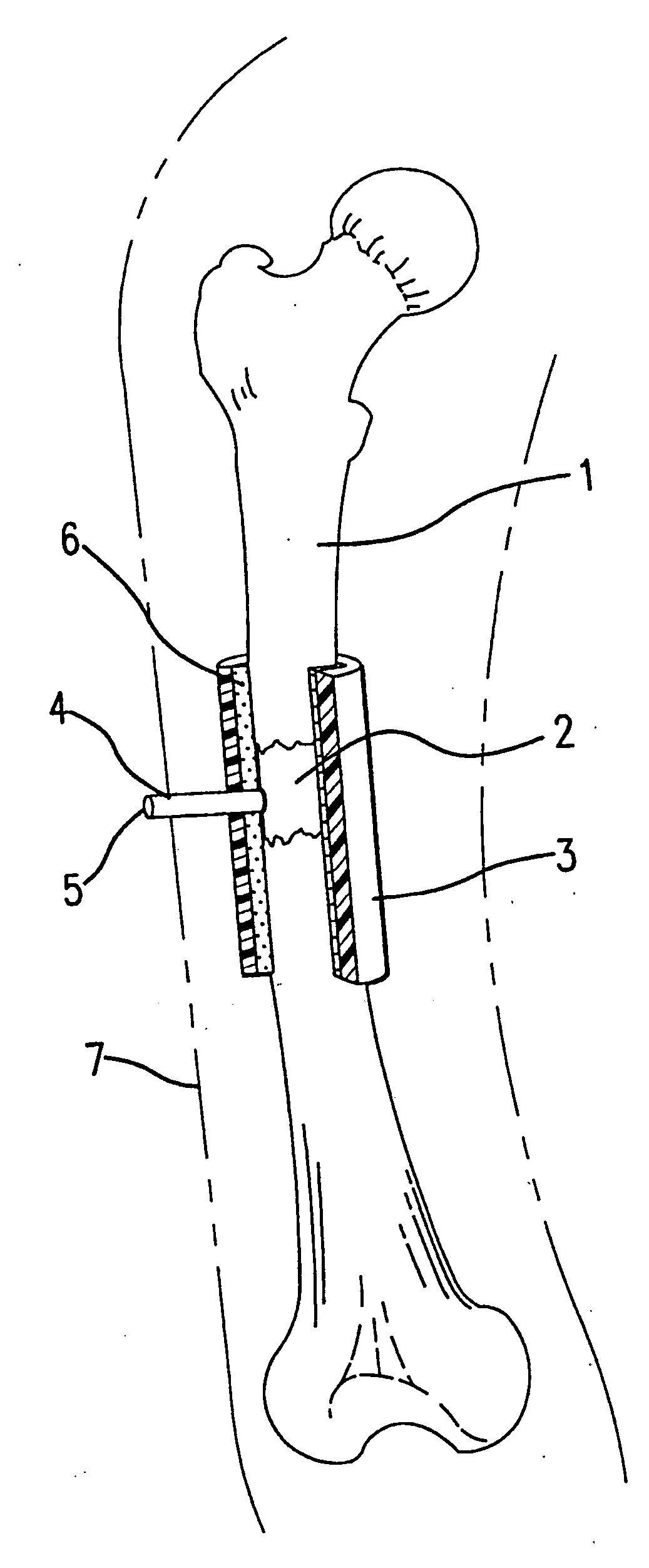 Bone regeneration device for bones, and method of use