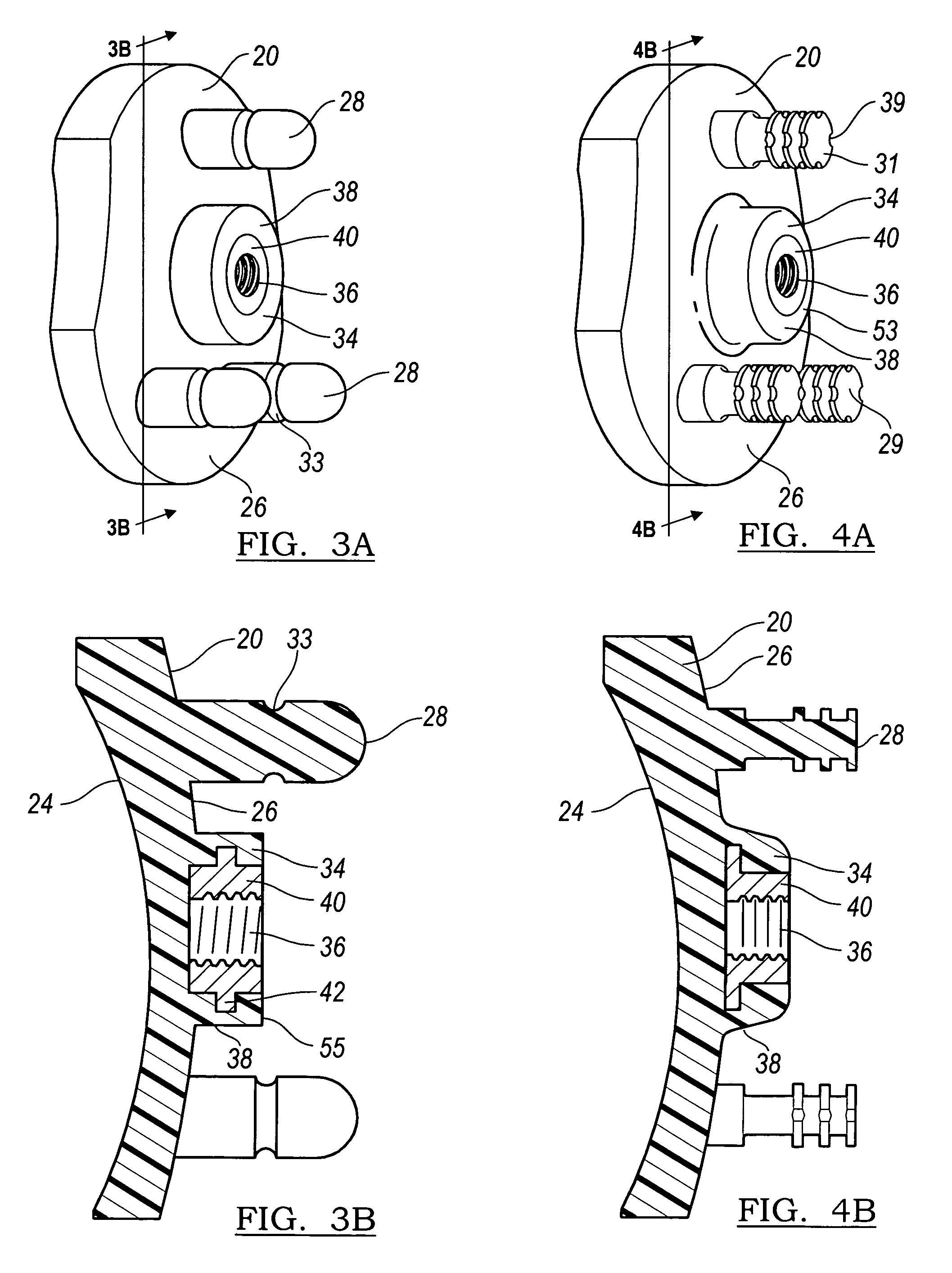 Modular center pegged glenoid