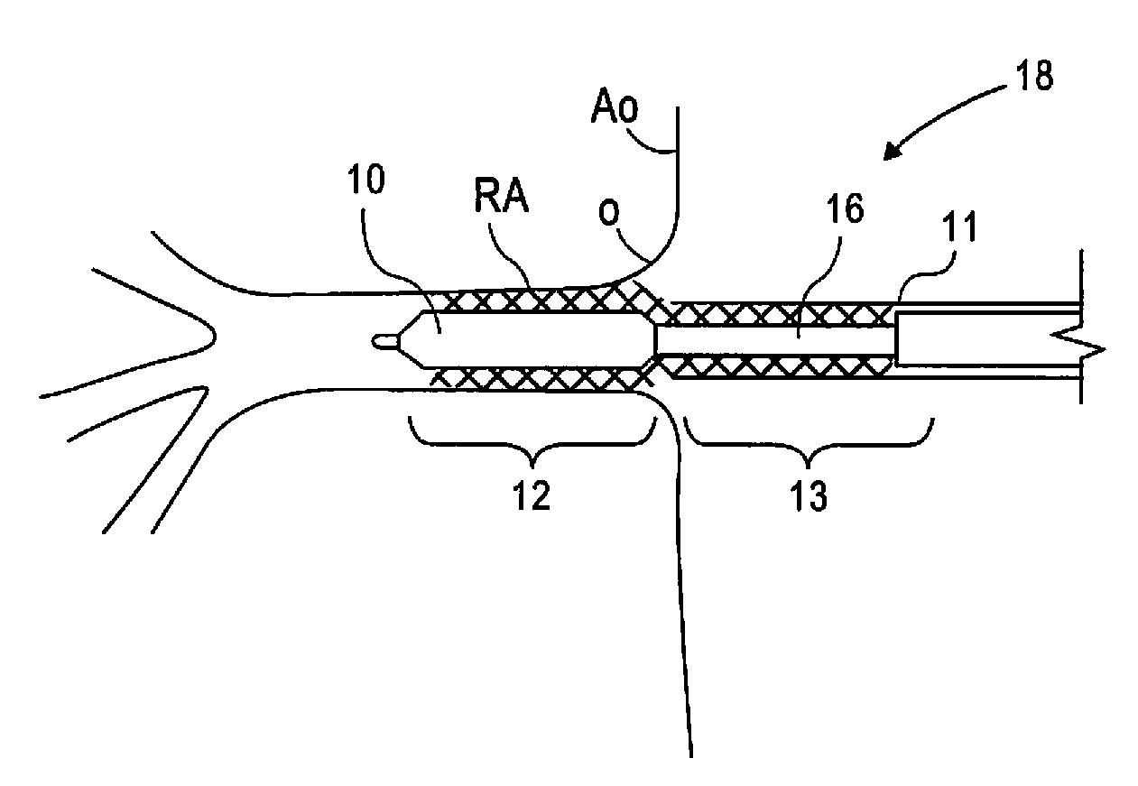 Stent and stent delivery system for side-branch locations in a conduit