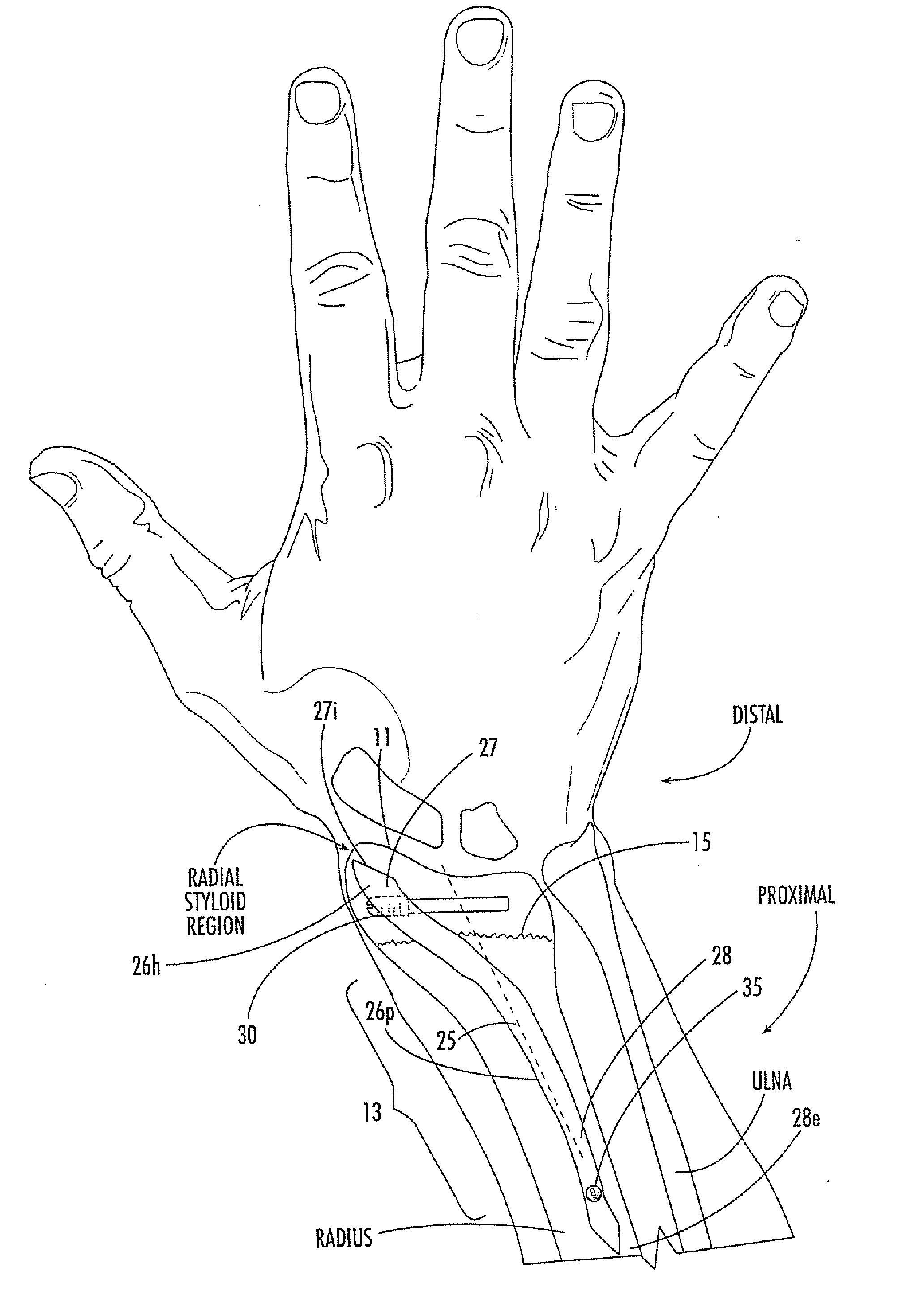 Intramedullary interlocking fixation devices for the distal radius