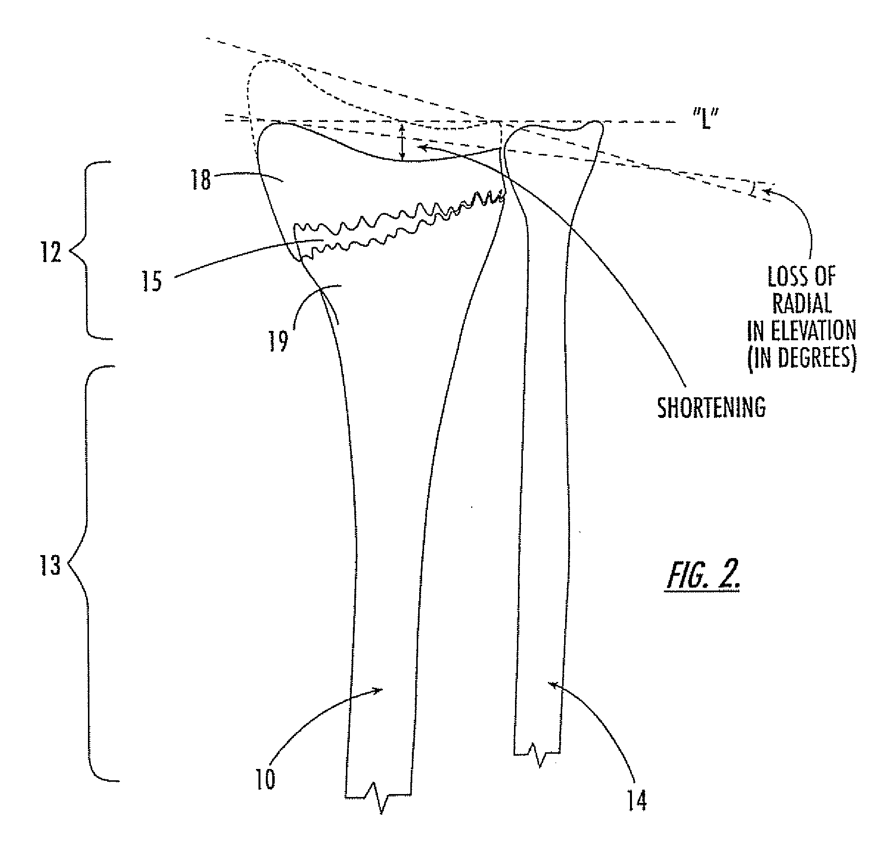 Intramedullary interlocking fixation devices for the distal radius