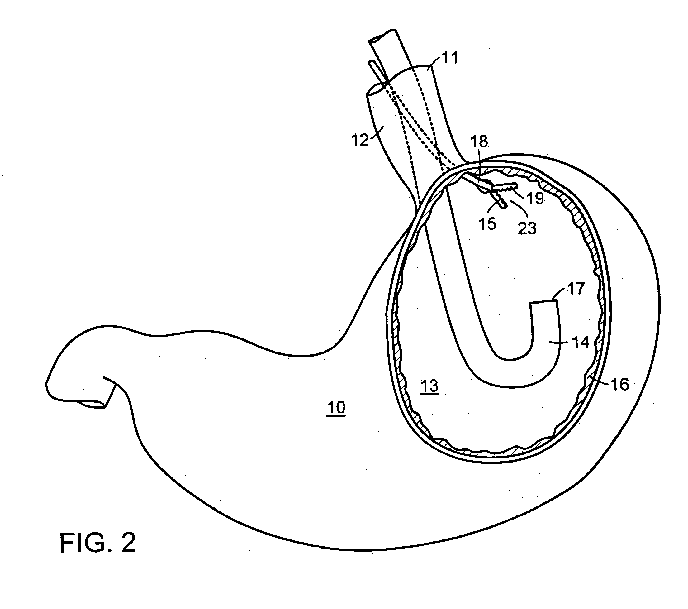 Methods and devices for tissue reconfiguration