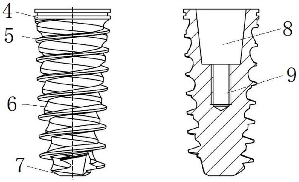 Multi-vector stress dispersion interlocking configuration oral implant