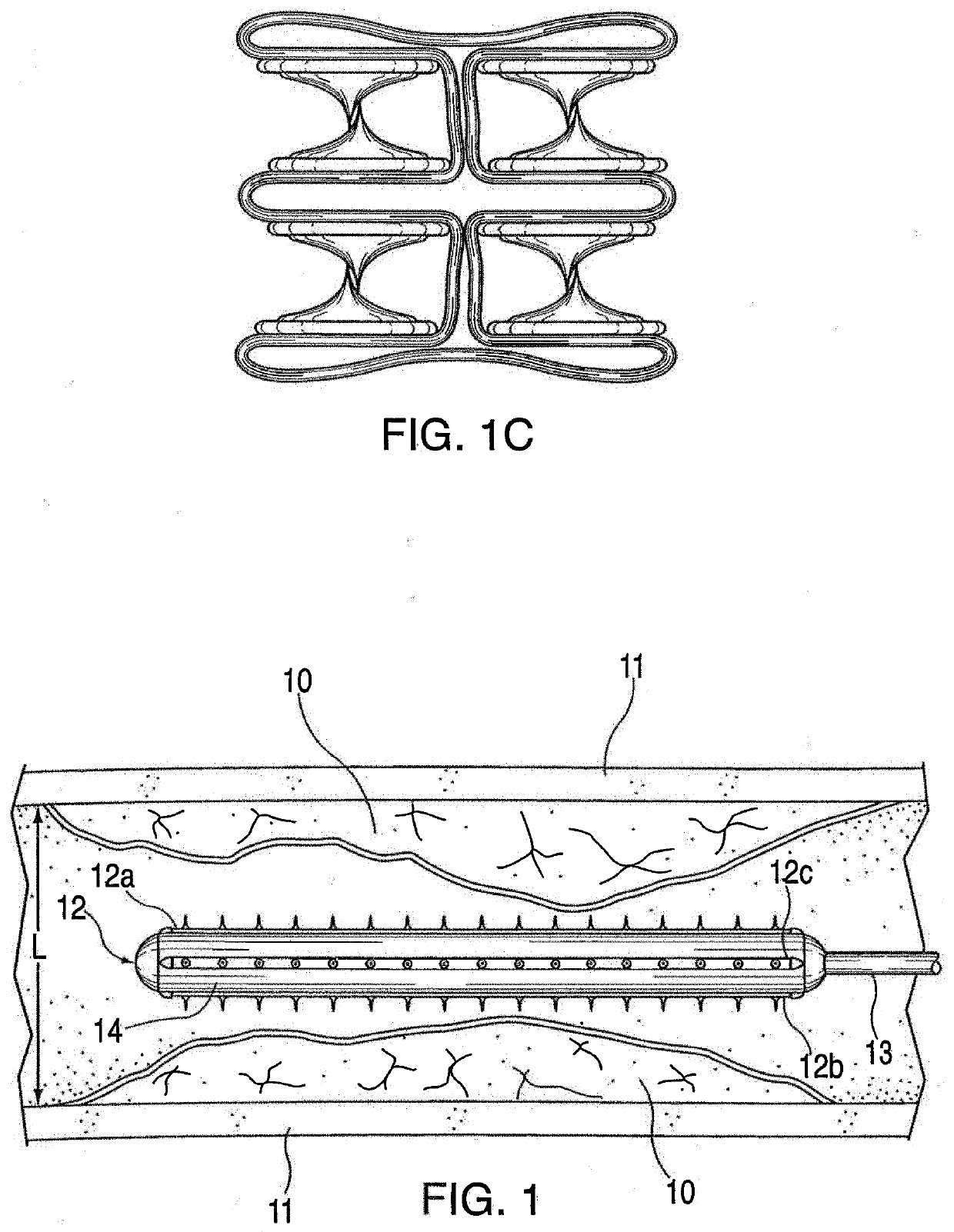 Pre-angioplasty serration of atherosclerotic plaque enabling low pressure balloon angioplasty & avoidance of stenting