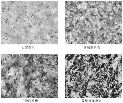 Application of VMP1 gene in pathological diagnosis of glioblastoma and preparation of kit thereof