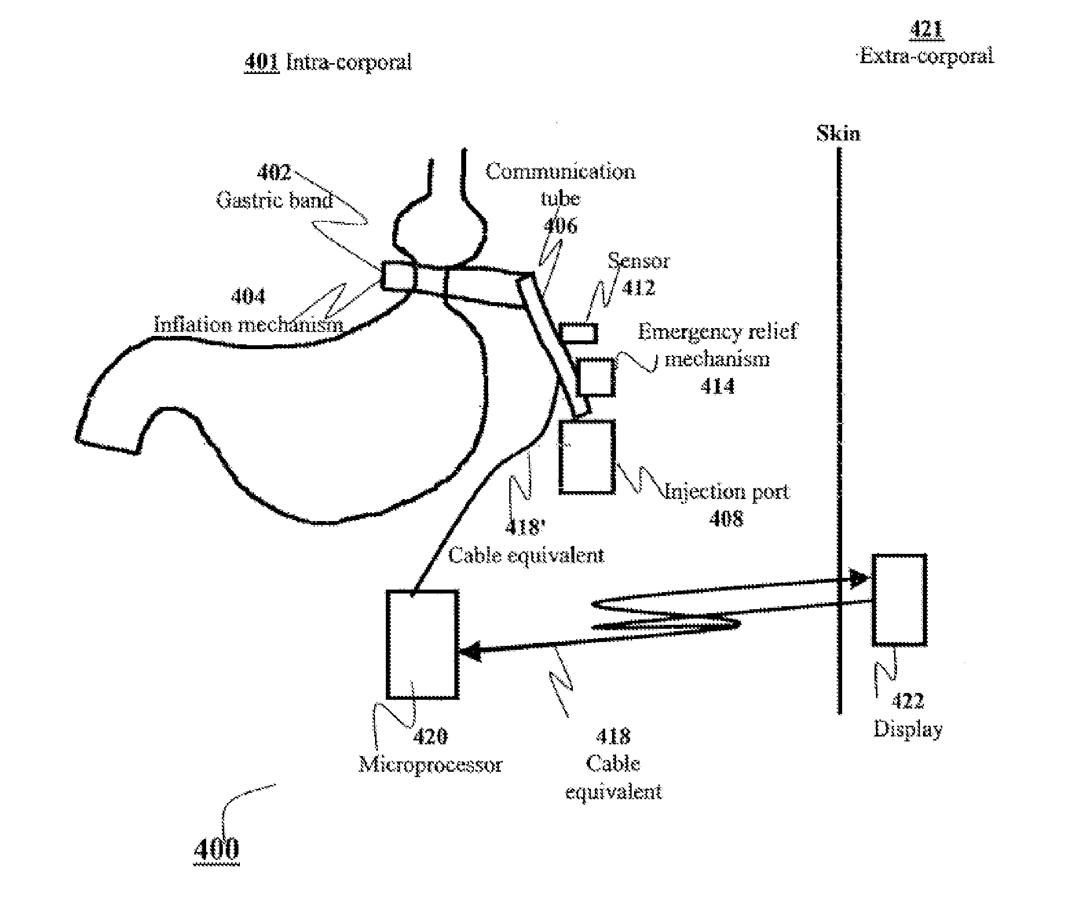 Apparatus and methods for corrective guidance of eating behavior after weight loss surgery