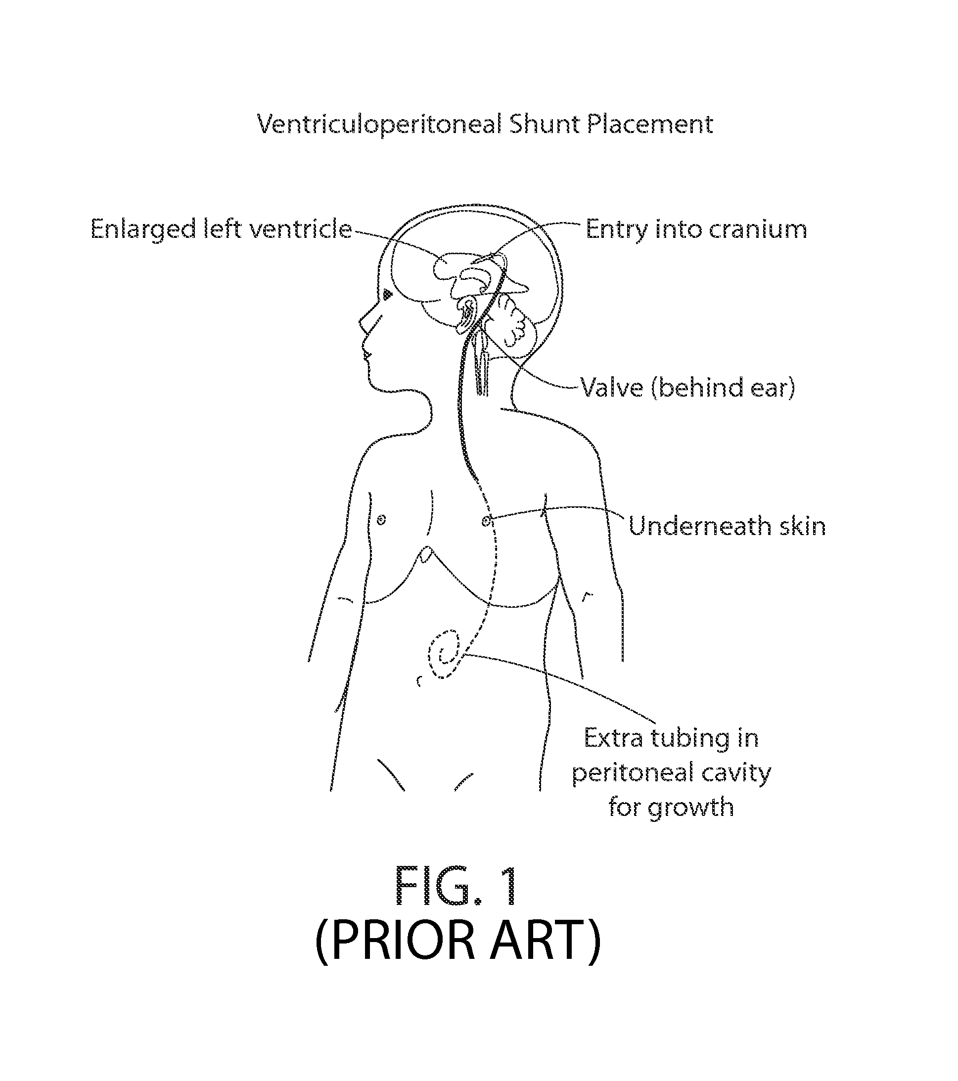 CSF shunt flow evaluation apparatus and method using a conformable expanded dynamic range thermosensor