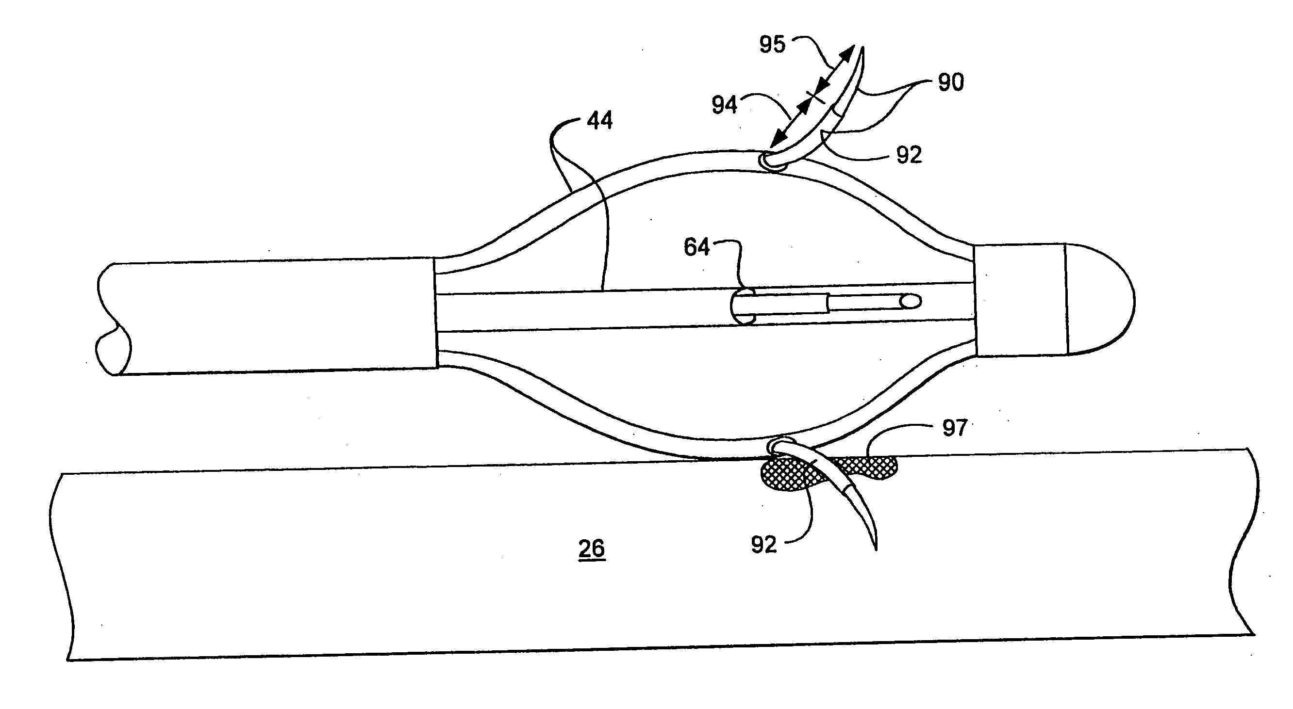 Sphincter treatment apparatus