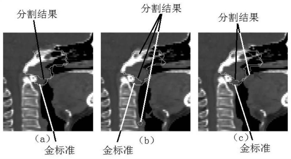 CT image-based nasopharyngeal carcinoma radiotherapy target region automatic sketching method