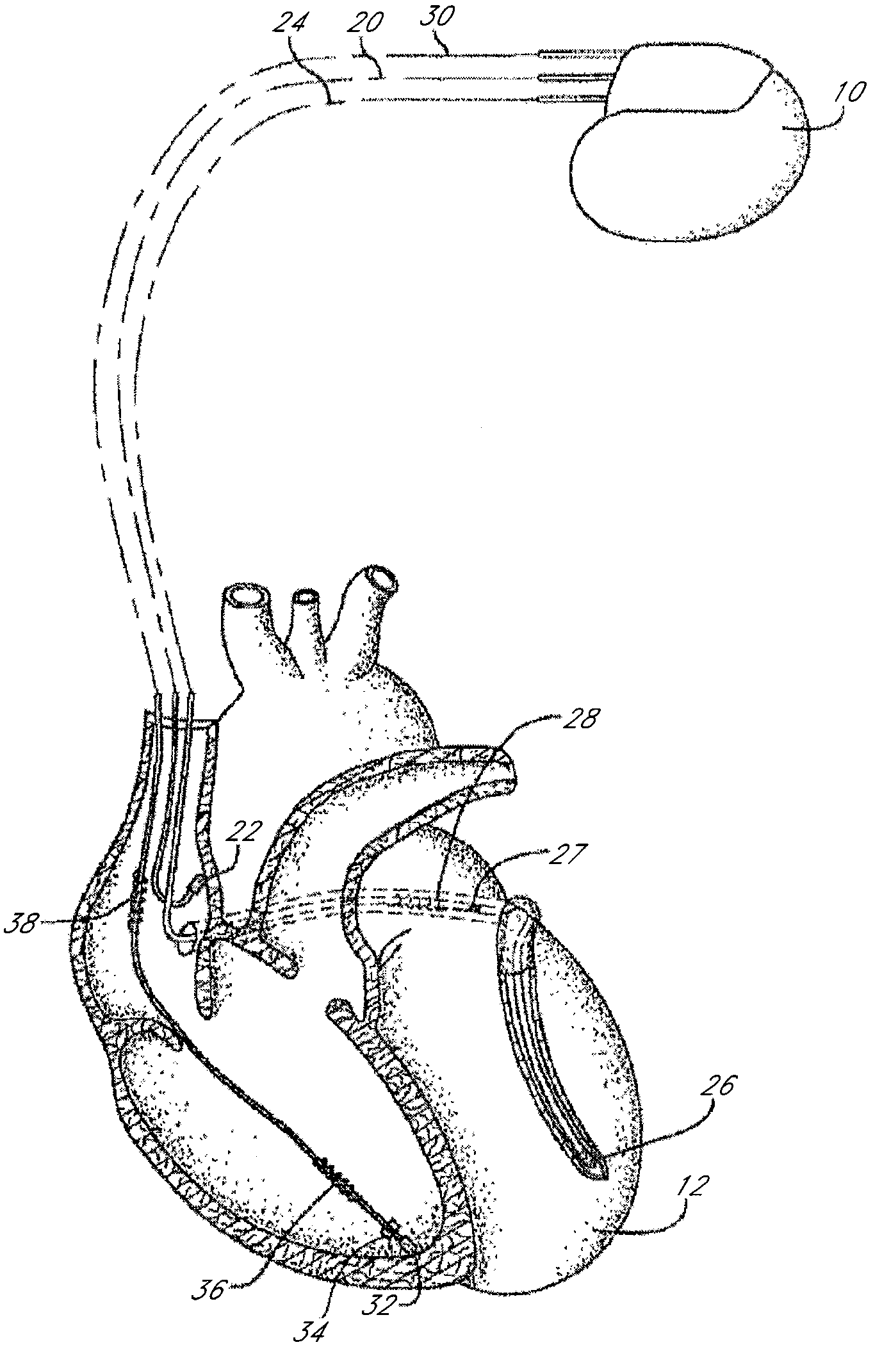 Implantable cardiac stimulation device with respiratory modulated therapy delivery