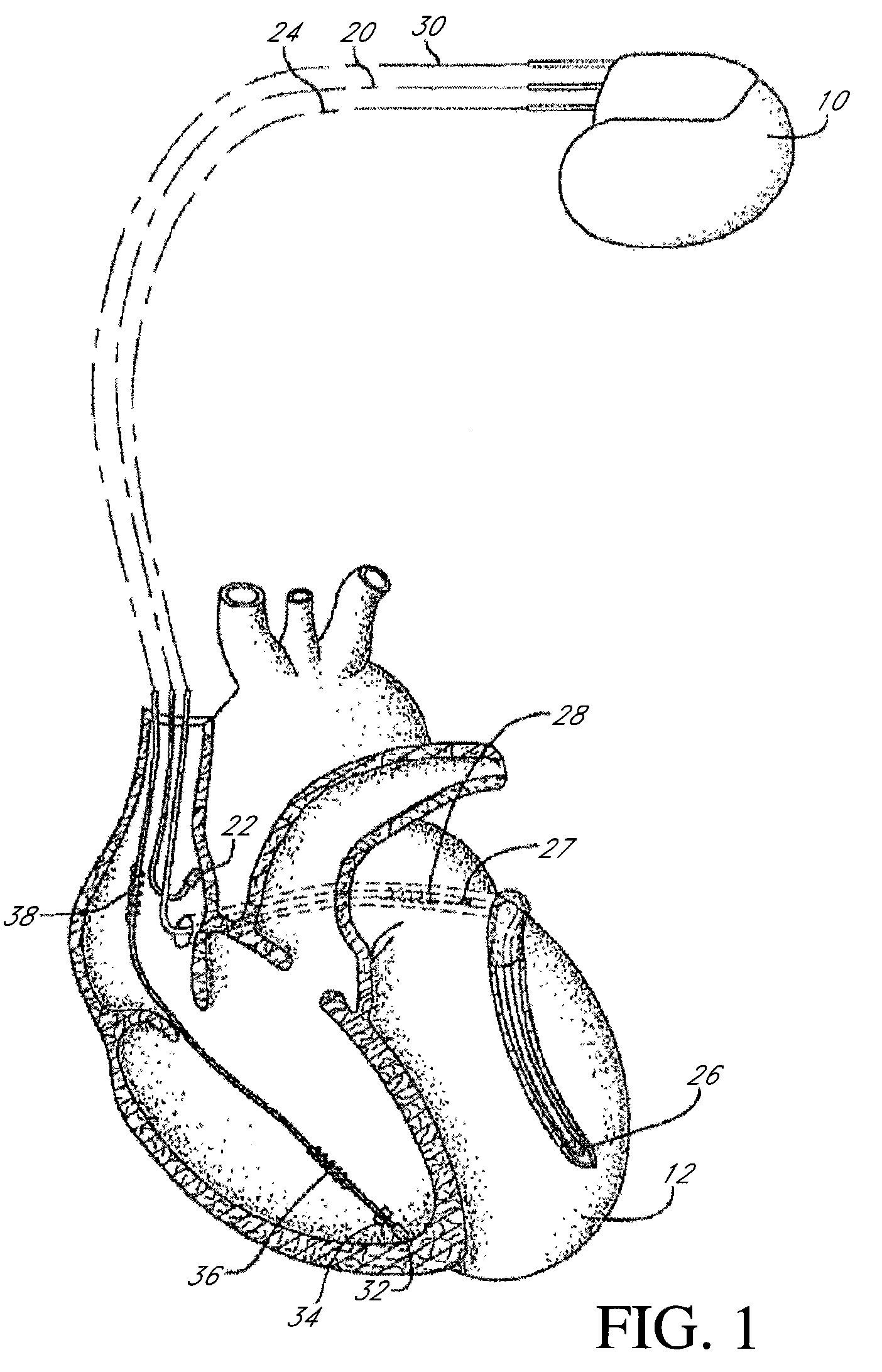 Implantable cardiac stimulation device with respiratory modulated therapy delivery