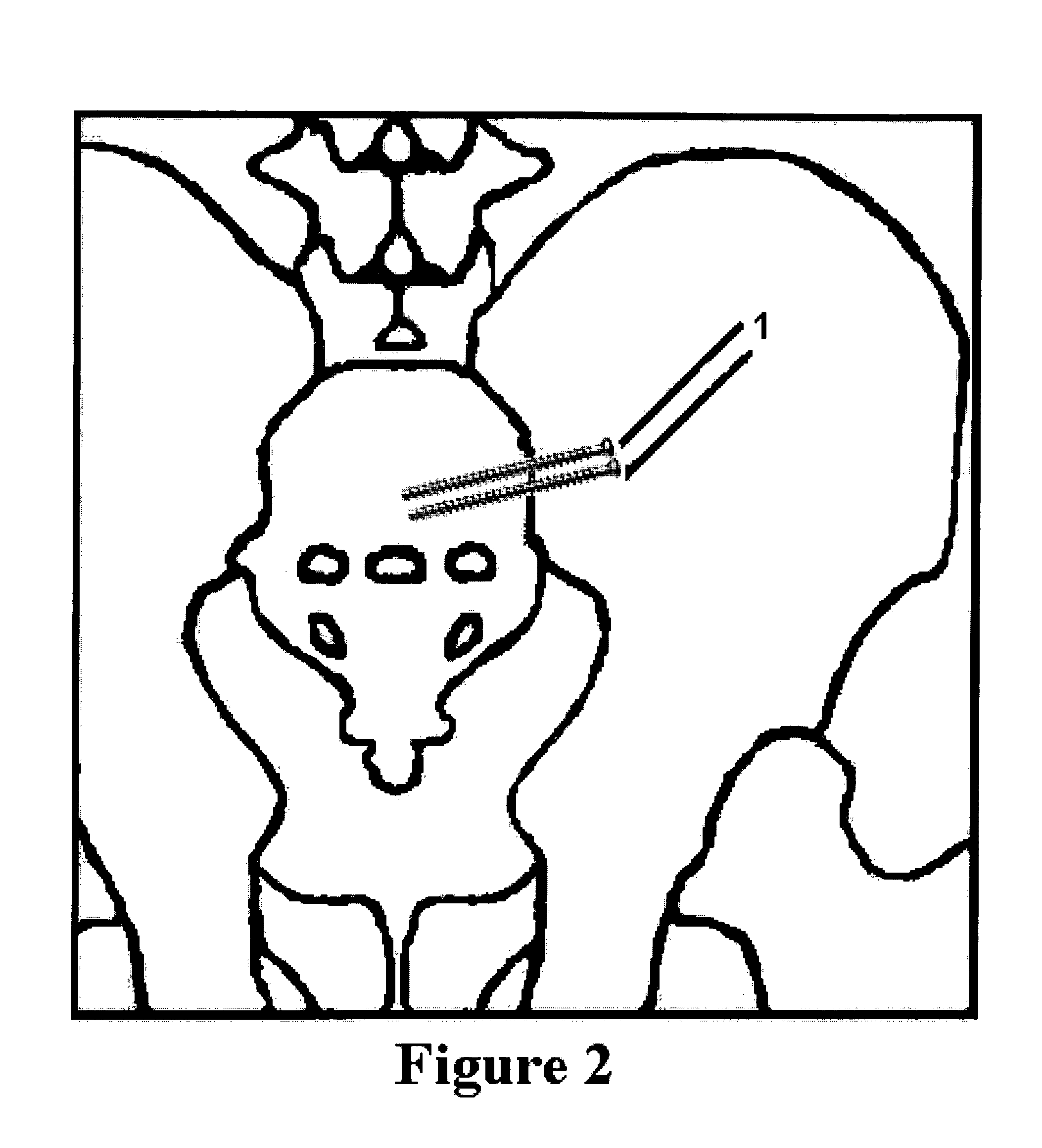 Method and apparatus for minimally invasive treatment of unstable pelvic ring injuries