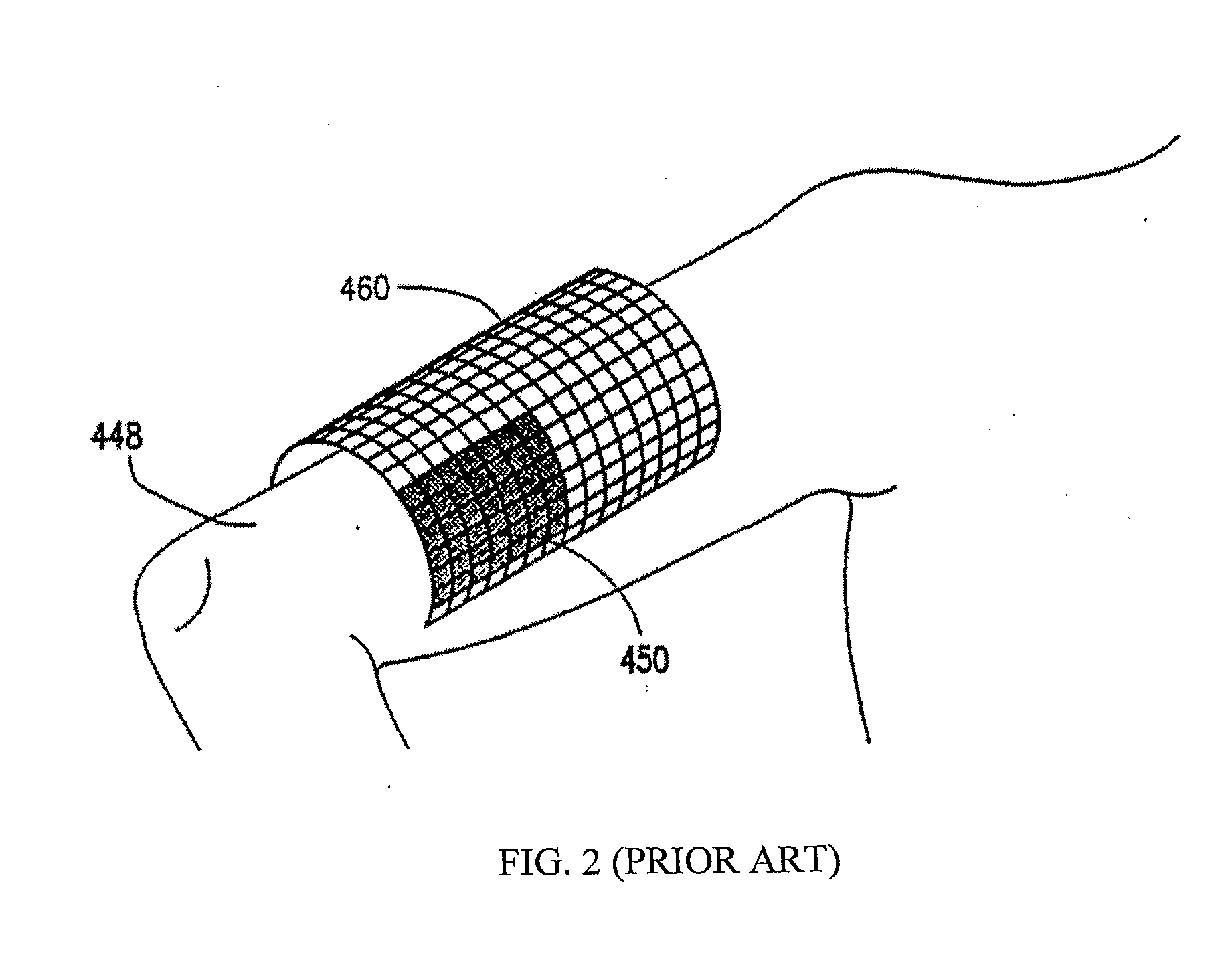 Bone Sonometer