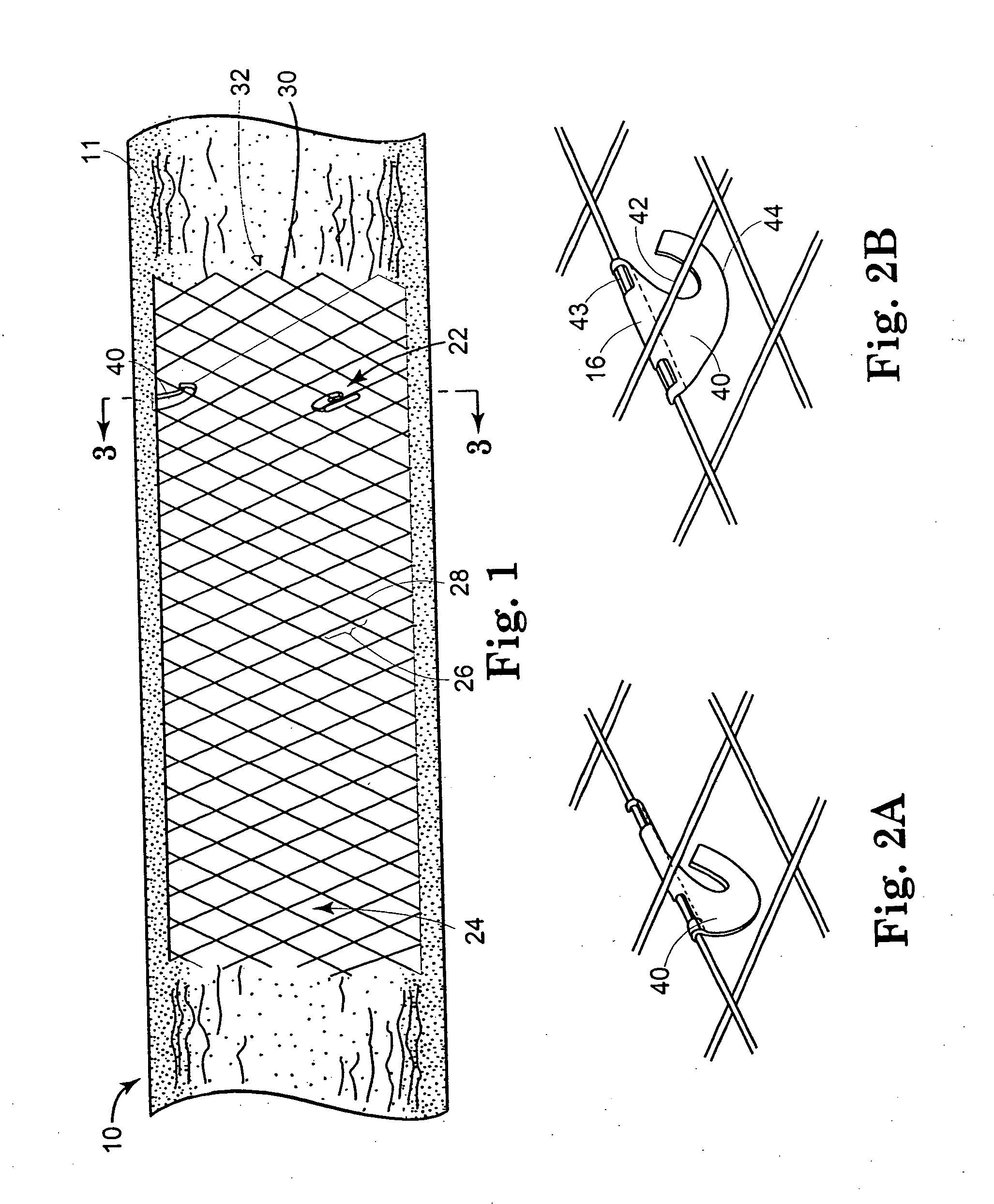 Retrievable stent and method of use thereof