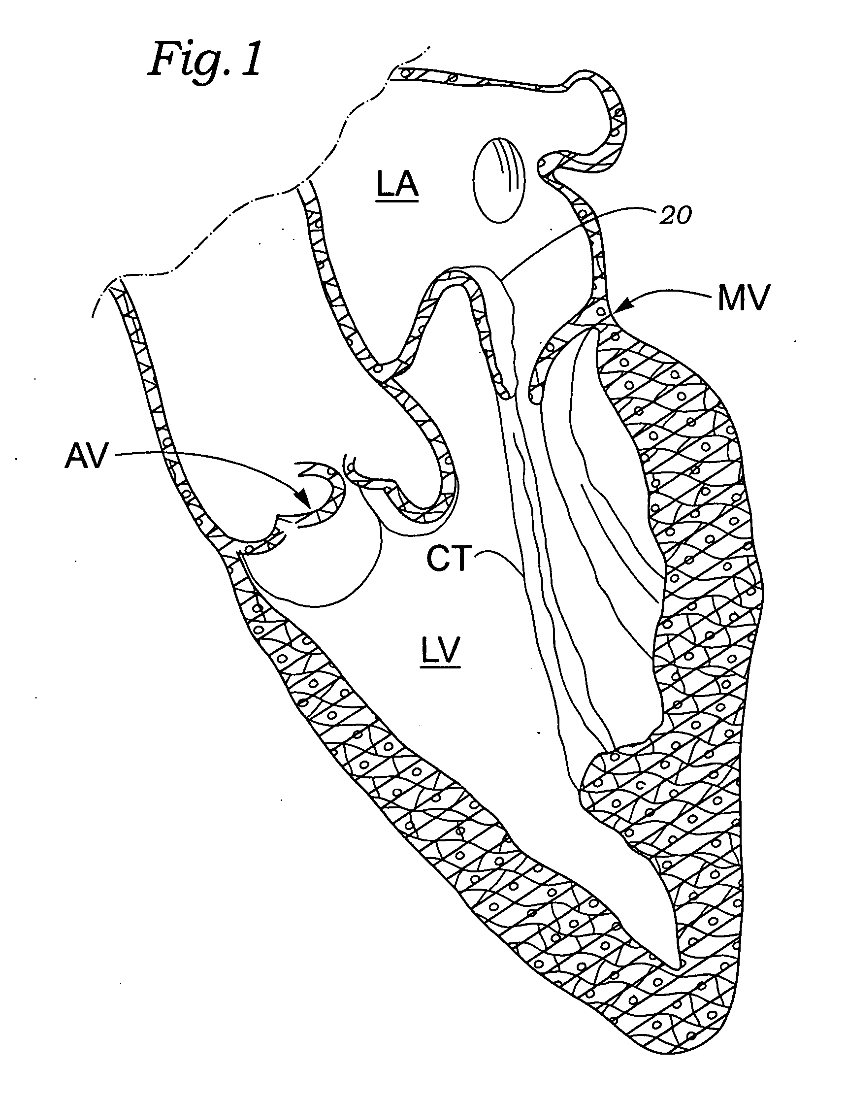 Annuloplasty ring for mitral valve prolapse