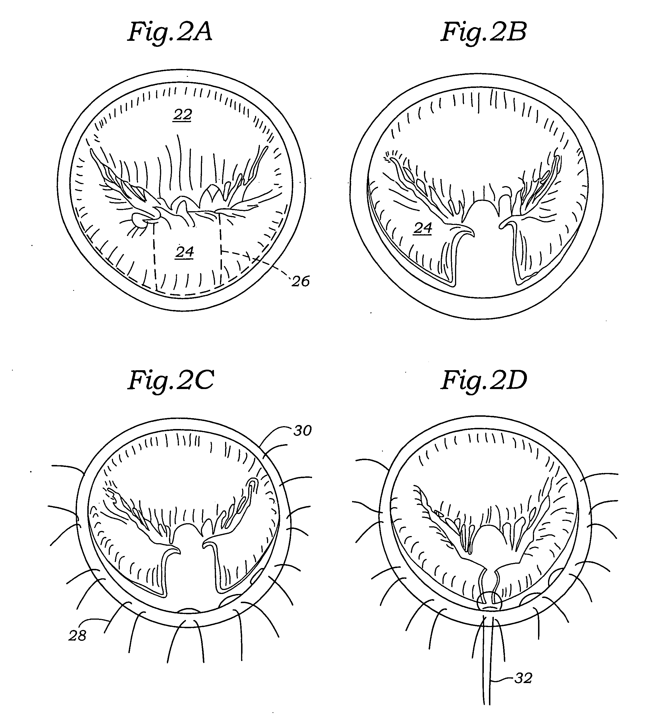 Annuloplasty ring for mitral valve prolapse