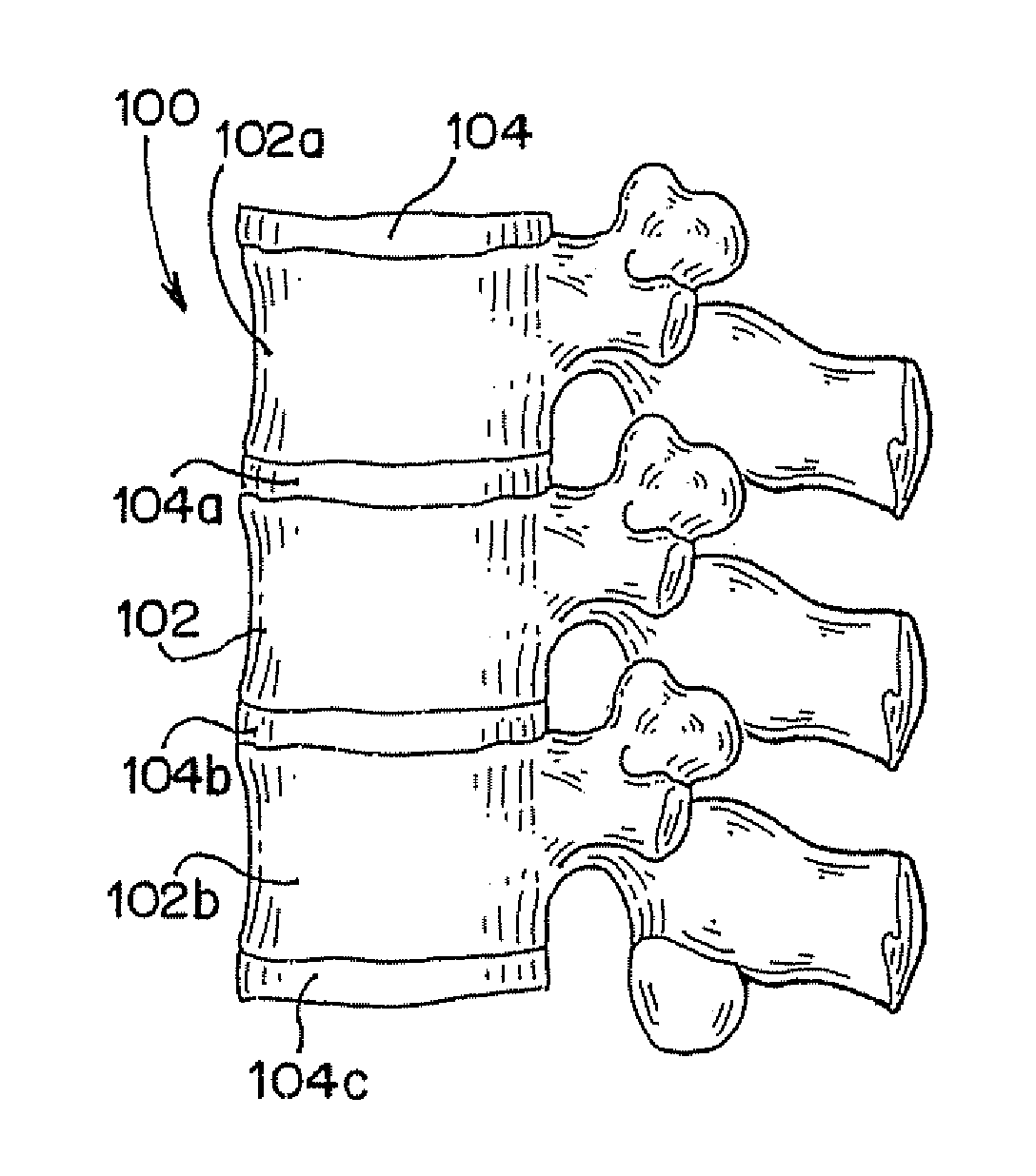 Devices For Limiting the Movement Of Material Introduced Between Layers Of Spinal Tissue