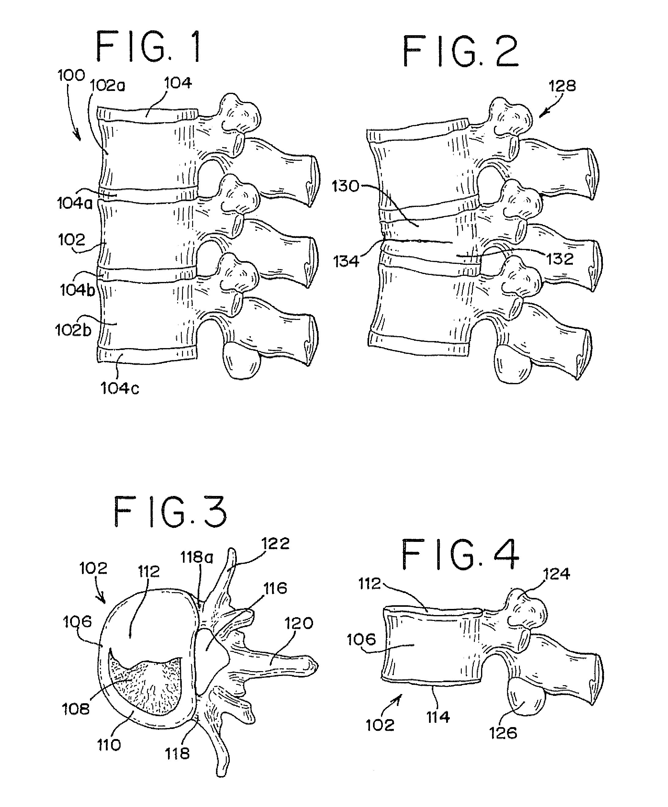 Devices For Limiting the Movement Of Material Introduced Between Layers Of Spinal Tissue