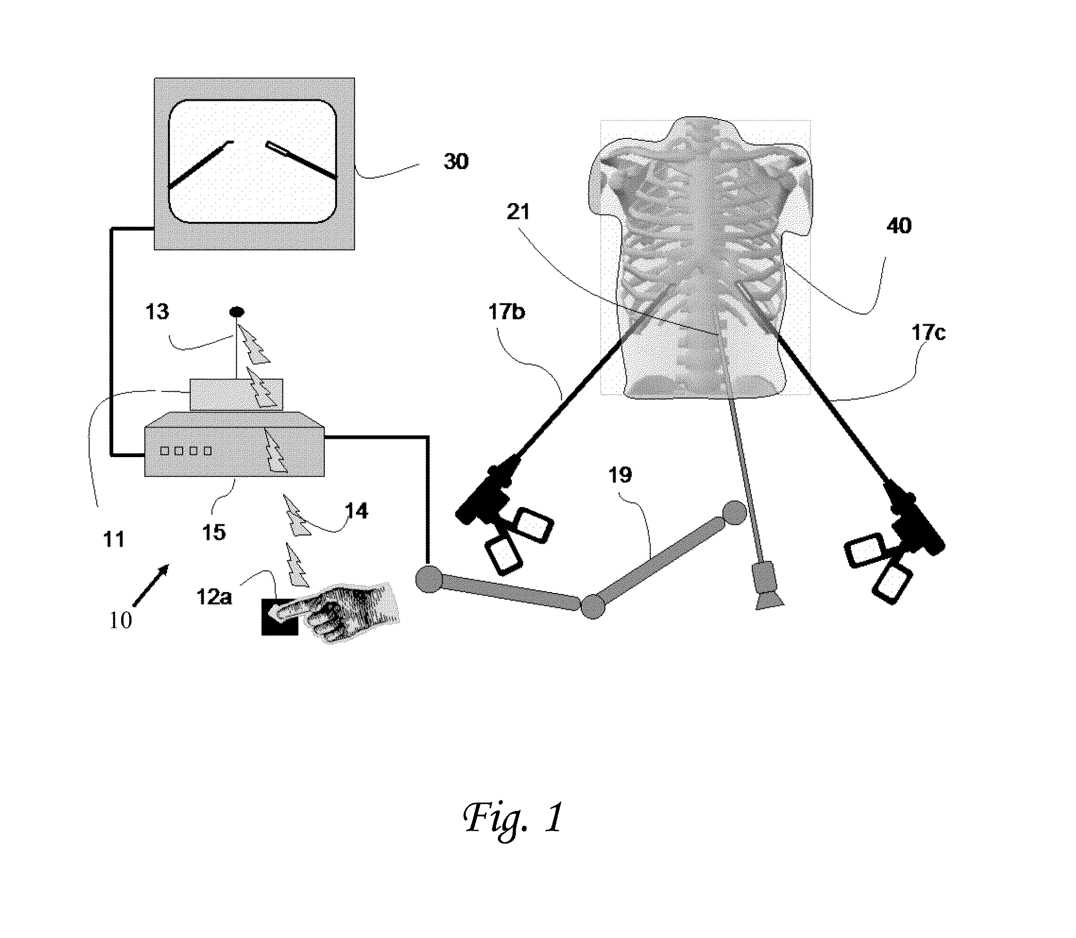 Device and methods of improving laparoscopic surgery