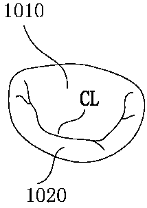 Cardiac valve repair system