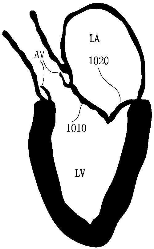 Cardiac valve repair system