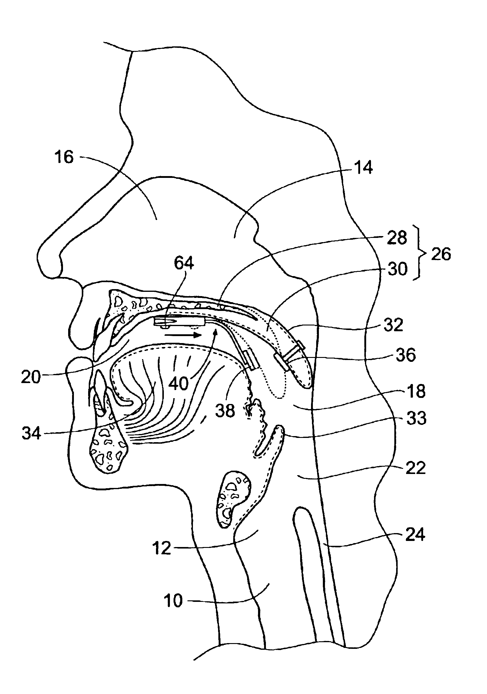 Systems and methods for moving and/or restraining the tongue in the oral cavity