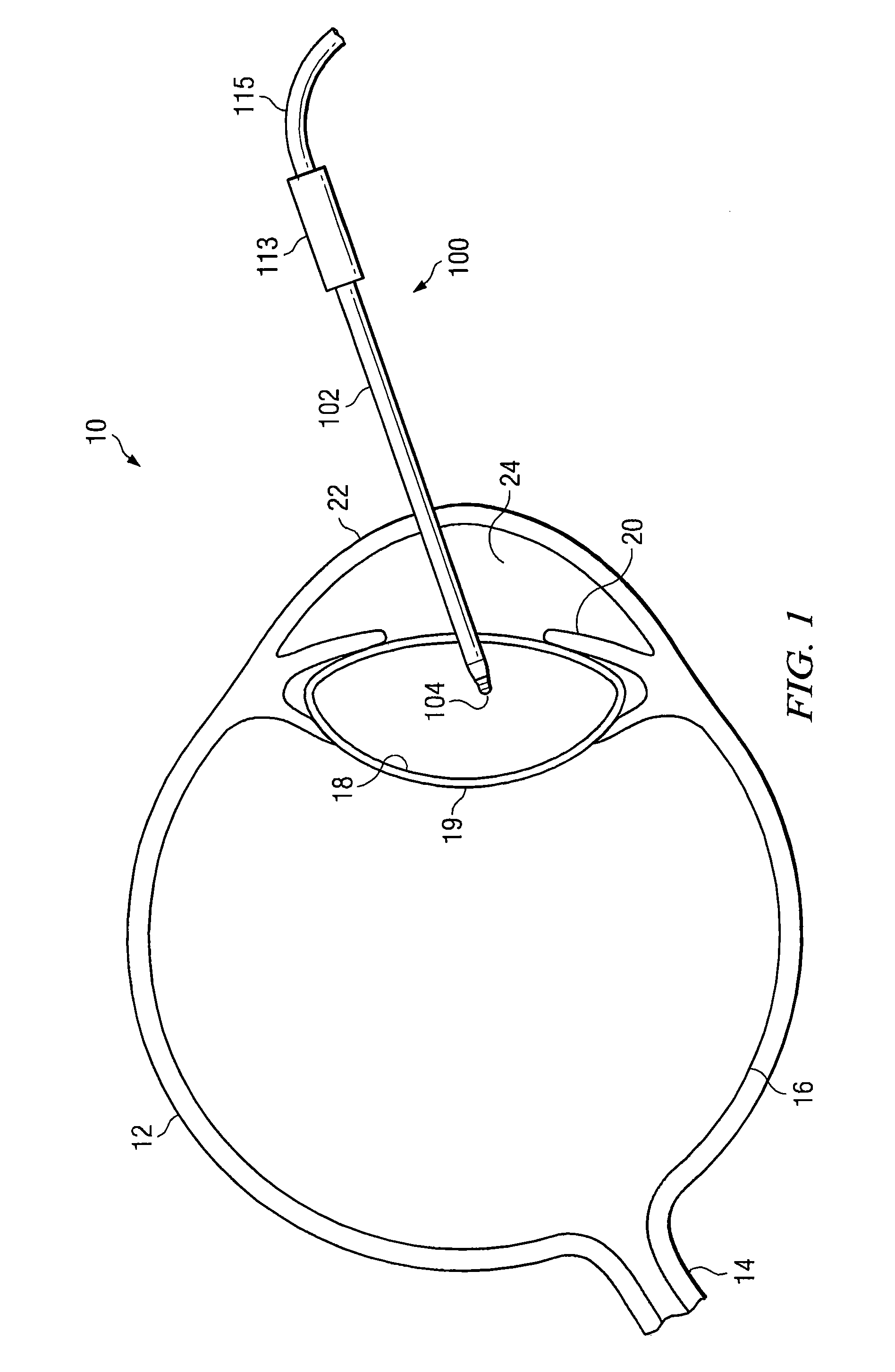 Distal Plastic End Infusion/Aspiration Tip