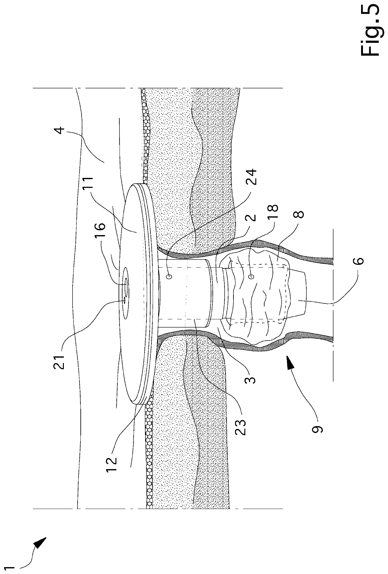 Prosthesis for enterostomy patients