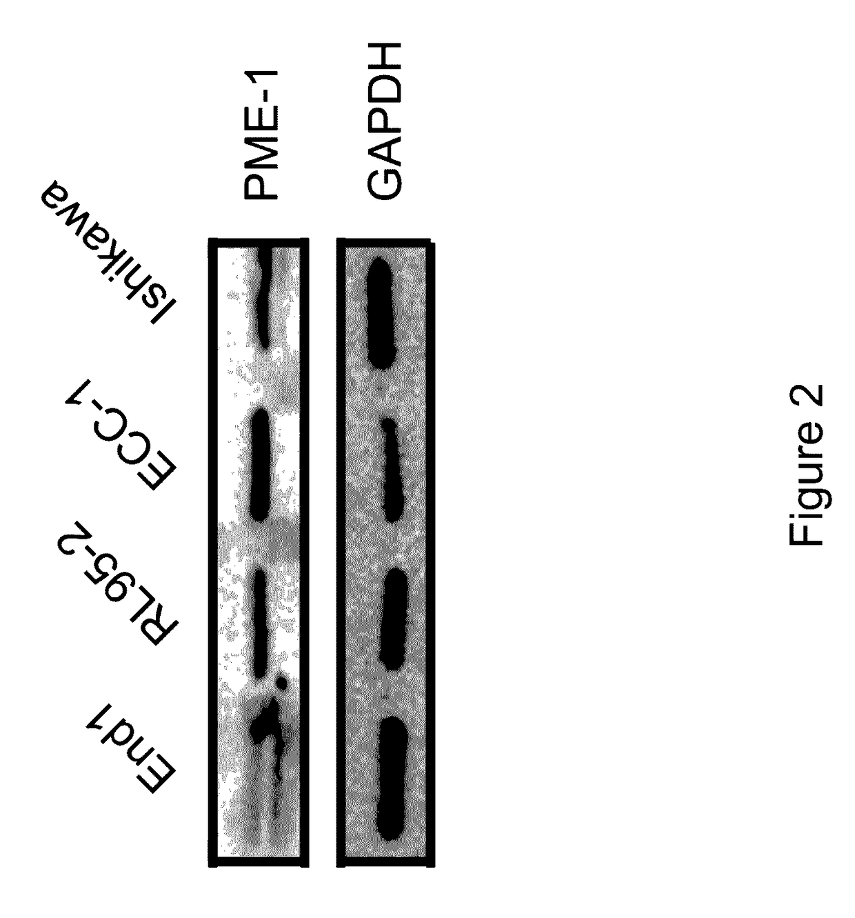 PME-1 as a biomarker to predict and diagnose an increased risk of endometrial cancer and gene silencing of PME-1 to inhibit epithelial to mesenchymal transition