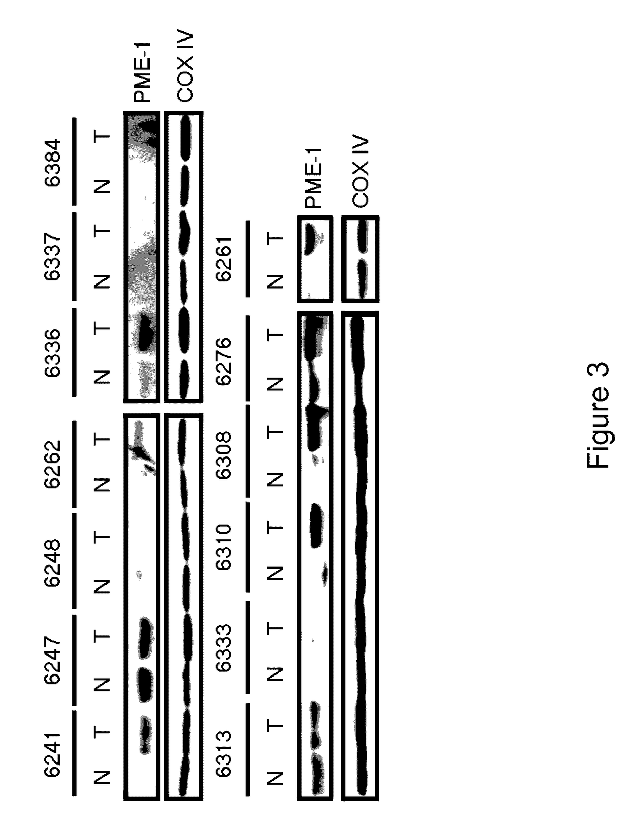 PME-1 as a biomarker to predict and diagnose an increased risk of endometrial cancer and gene silencing of PME-1 to inhibit epithelial to mesenchymal transition