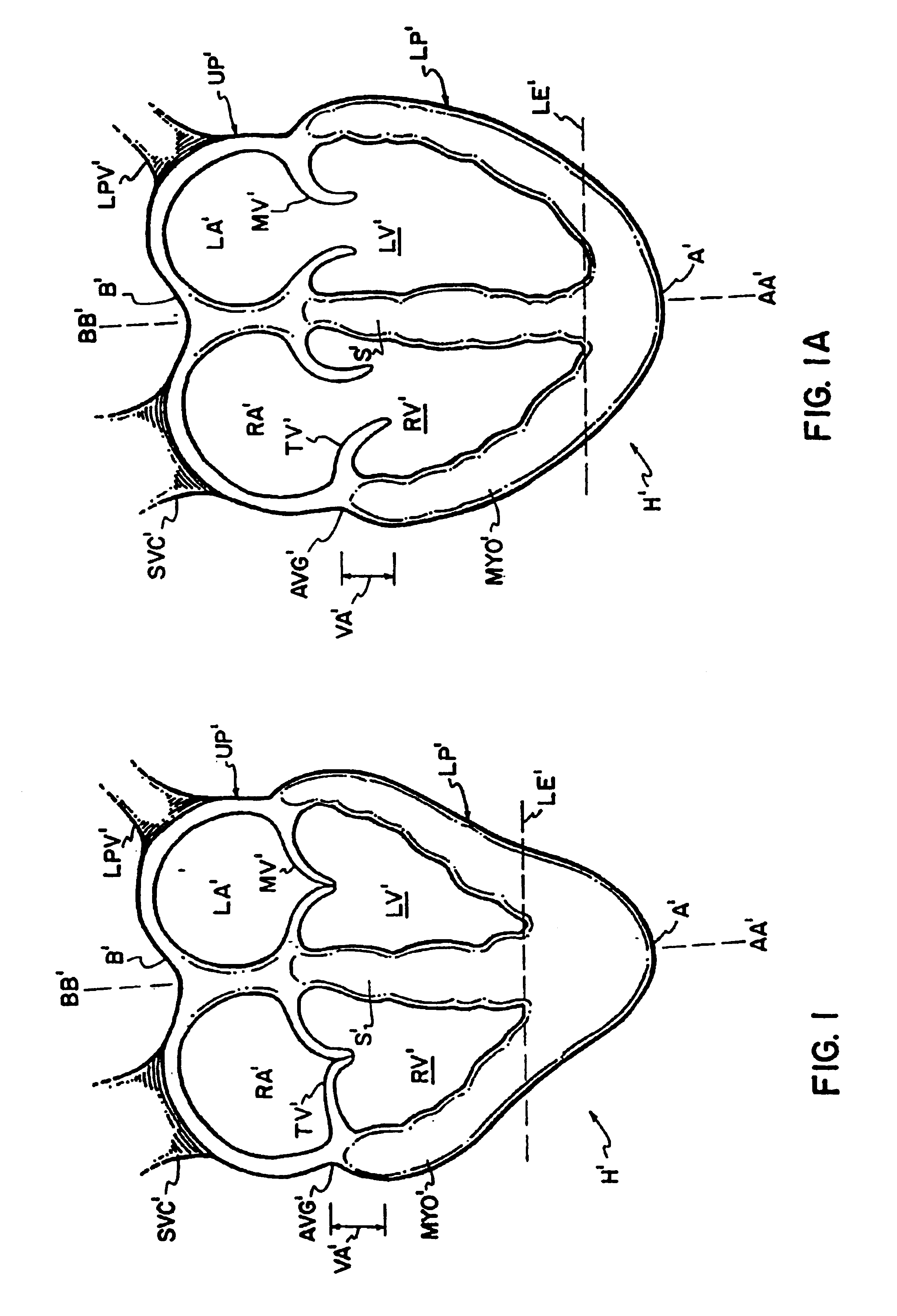 Cardiac disease treatment and device