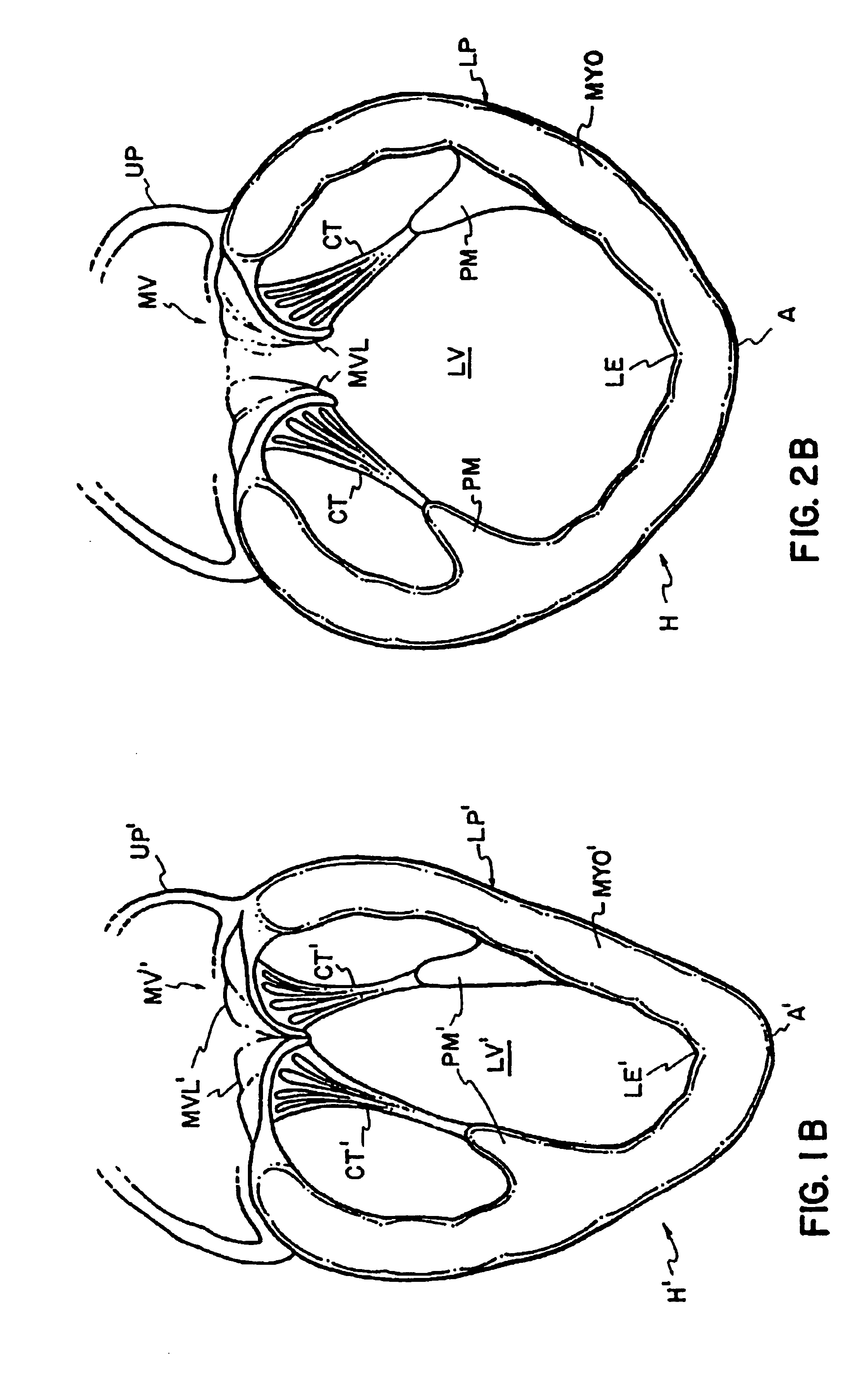 Cardiac disease treatment and device