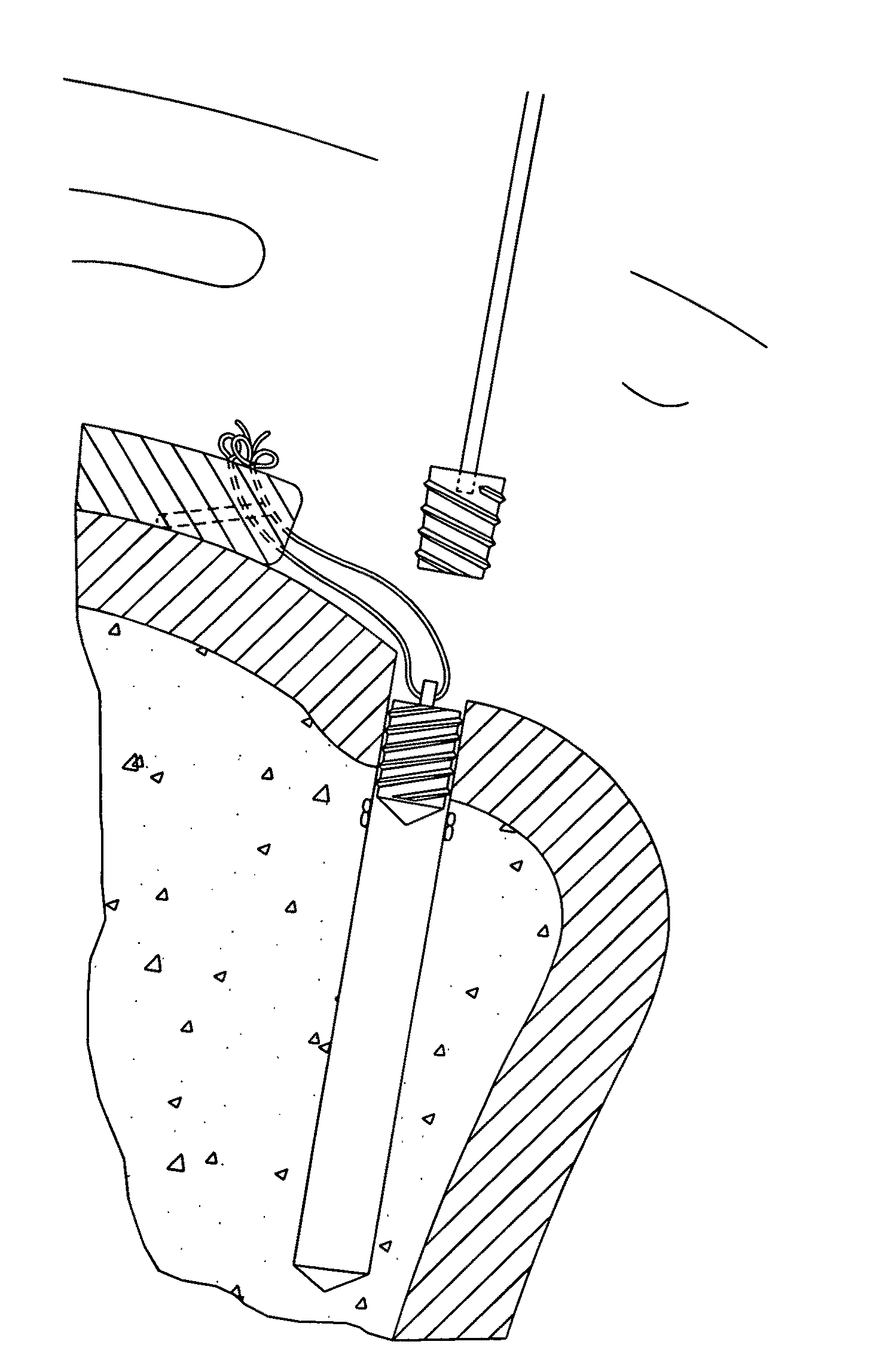 Method and apparatus for enhancing the fixation of bone and soft tissue anchors