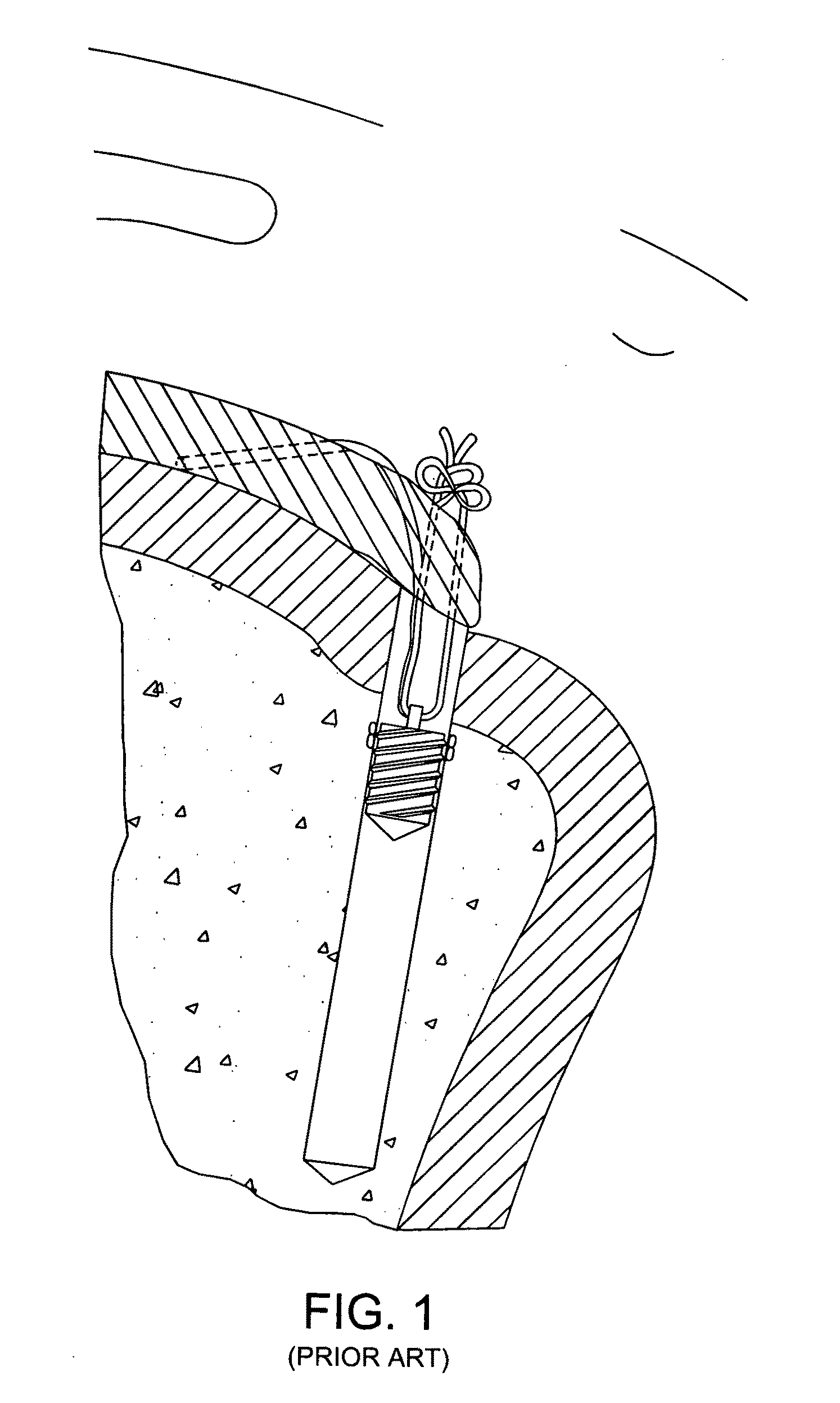 Method and apparatus for enhancing the fixation of bone and soft tissue anchors