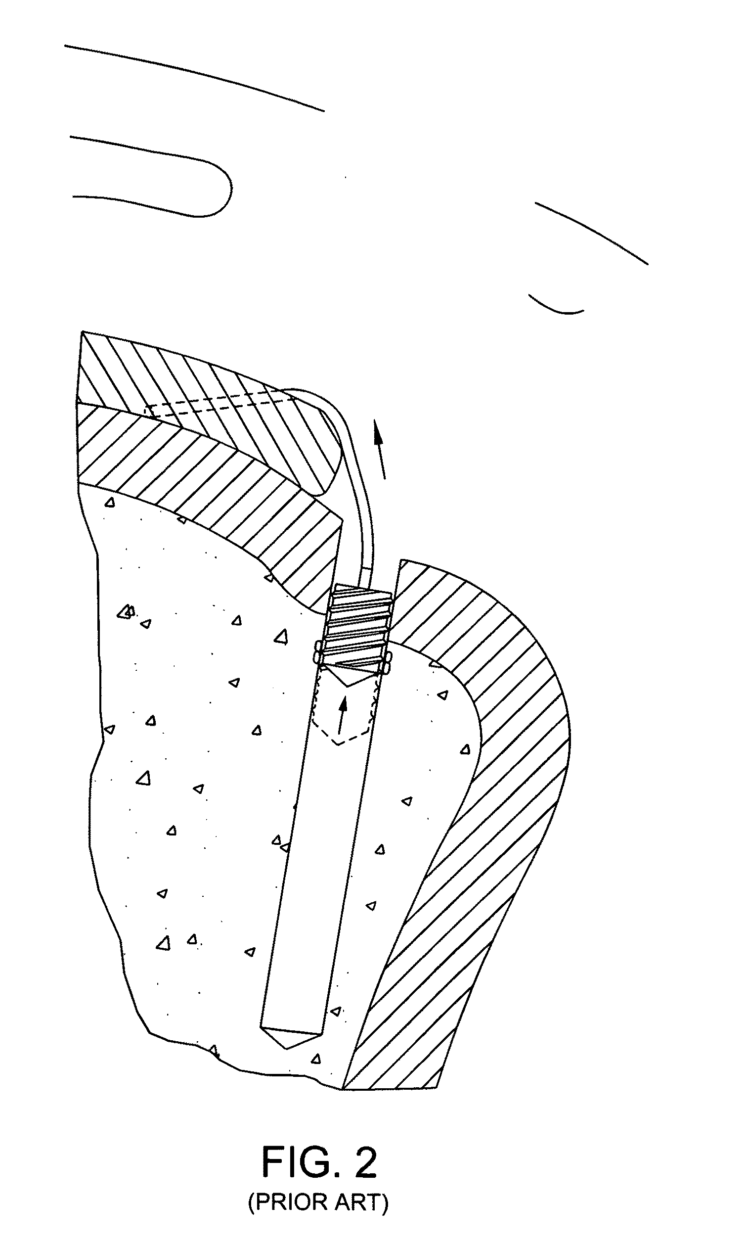 Method and apparatus for enhancing the fixation of bone and soft tissue anchors