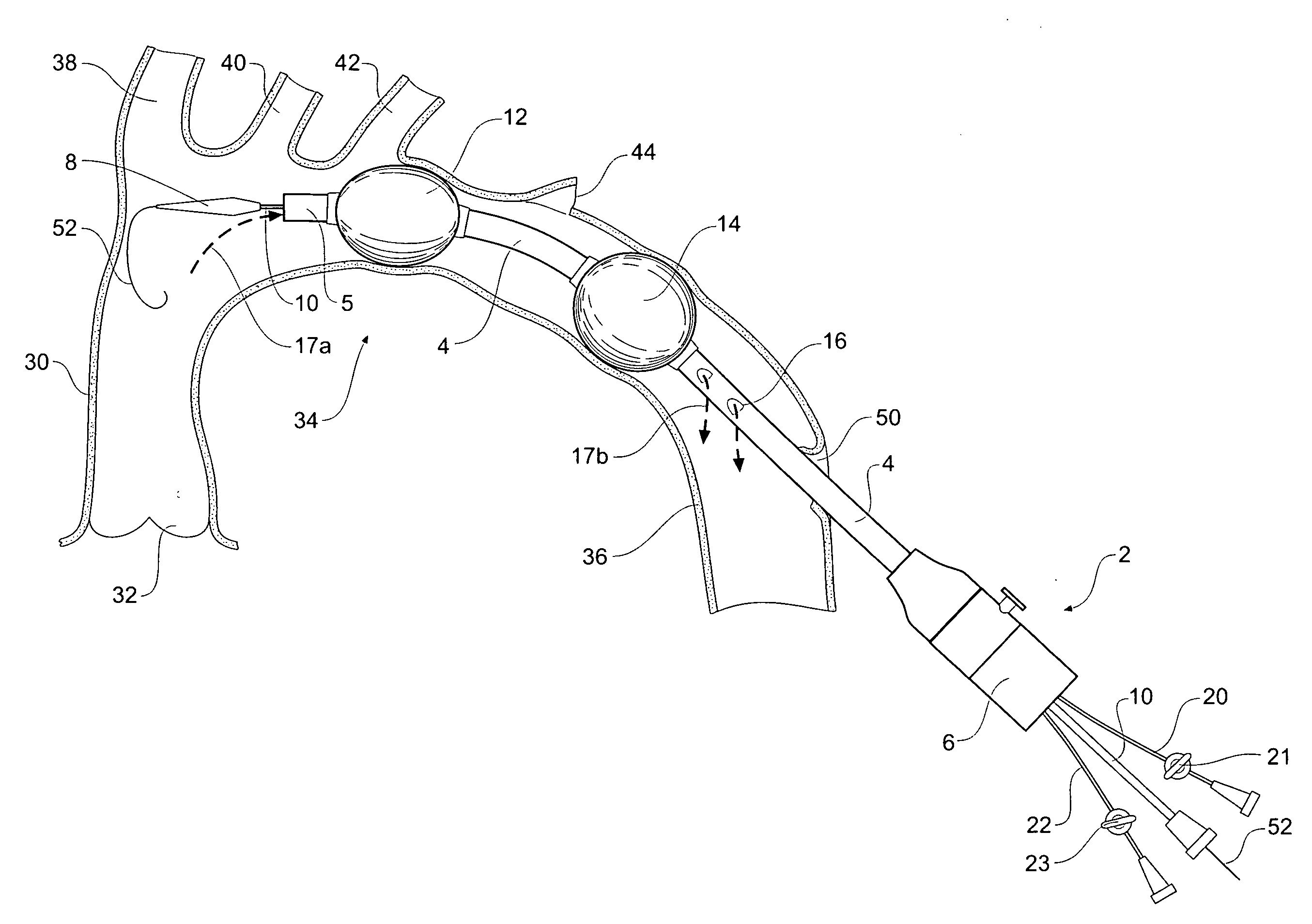 Emergency transection device