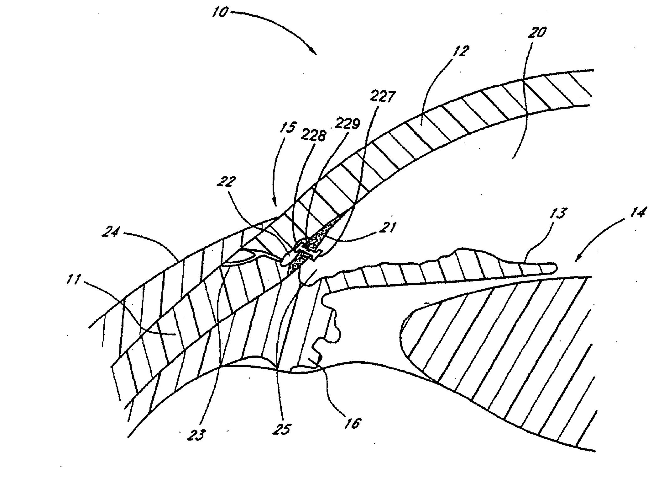 Devices and methods for glaucoma treatment