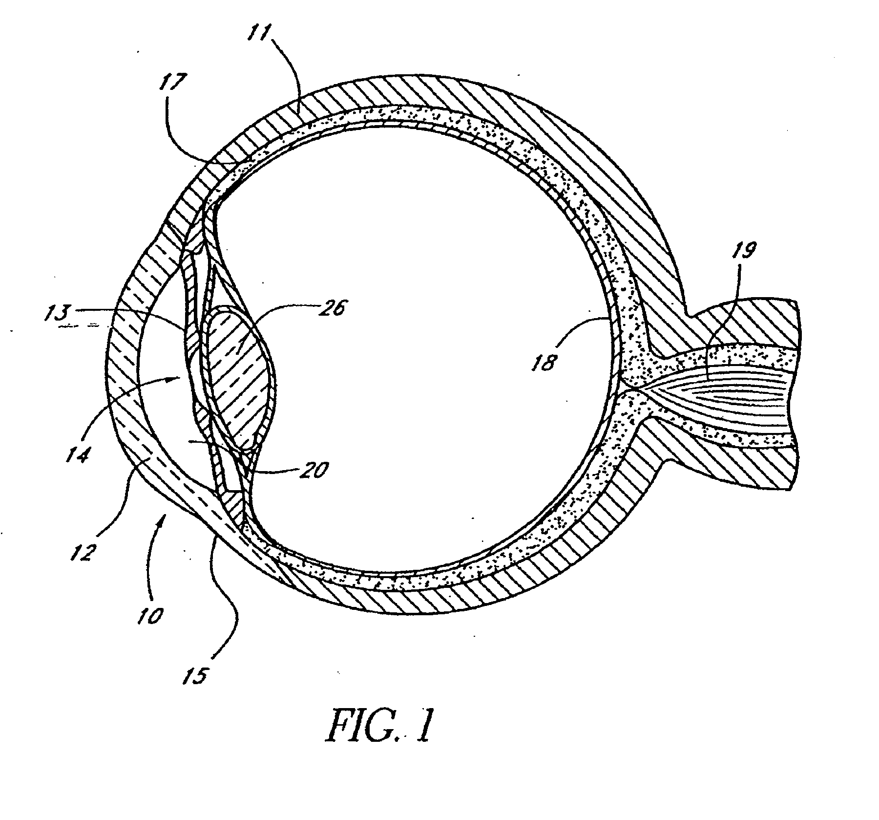 Devices and methods for glaucoma treatment