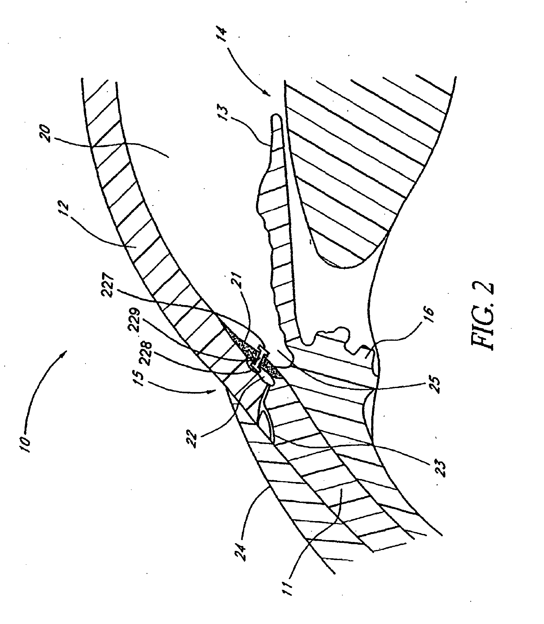 Devices and methods for glaucoma treatment