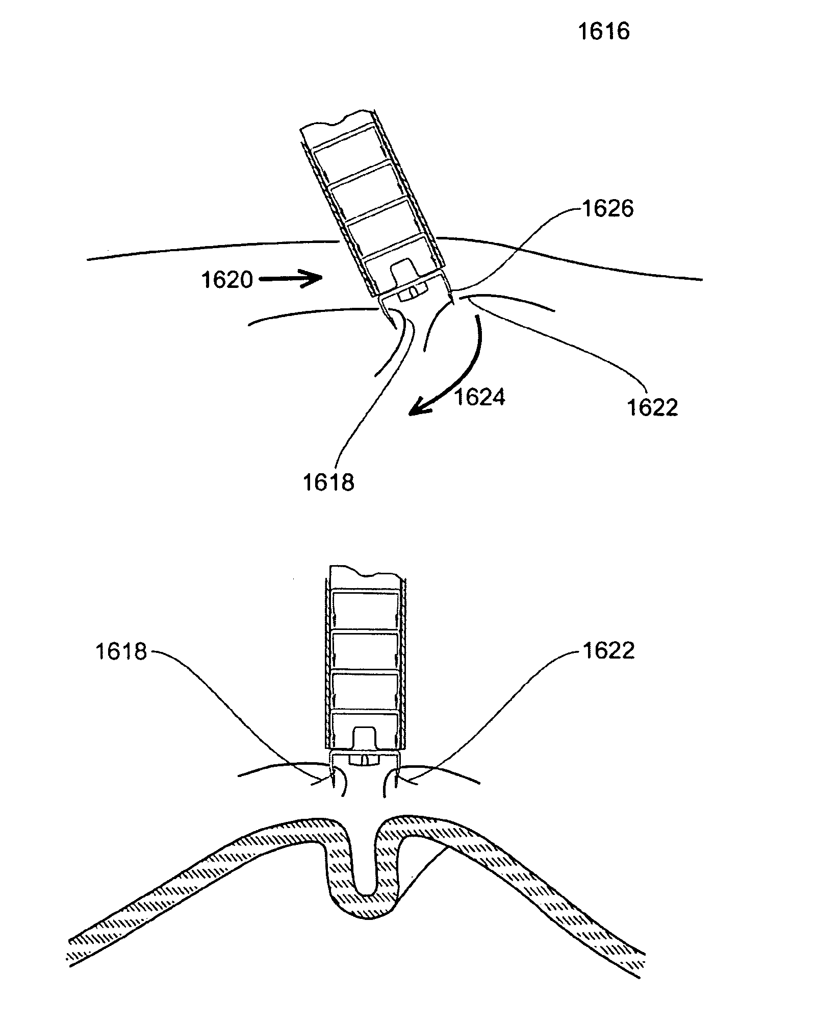 Methods for approximation and fastening of soft tissue