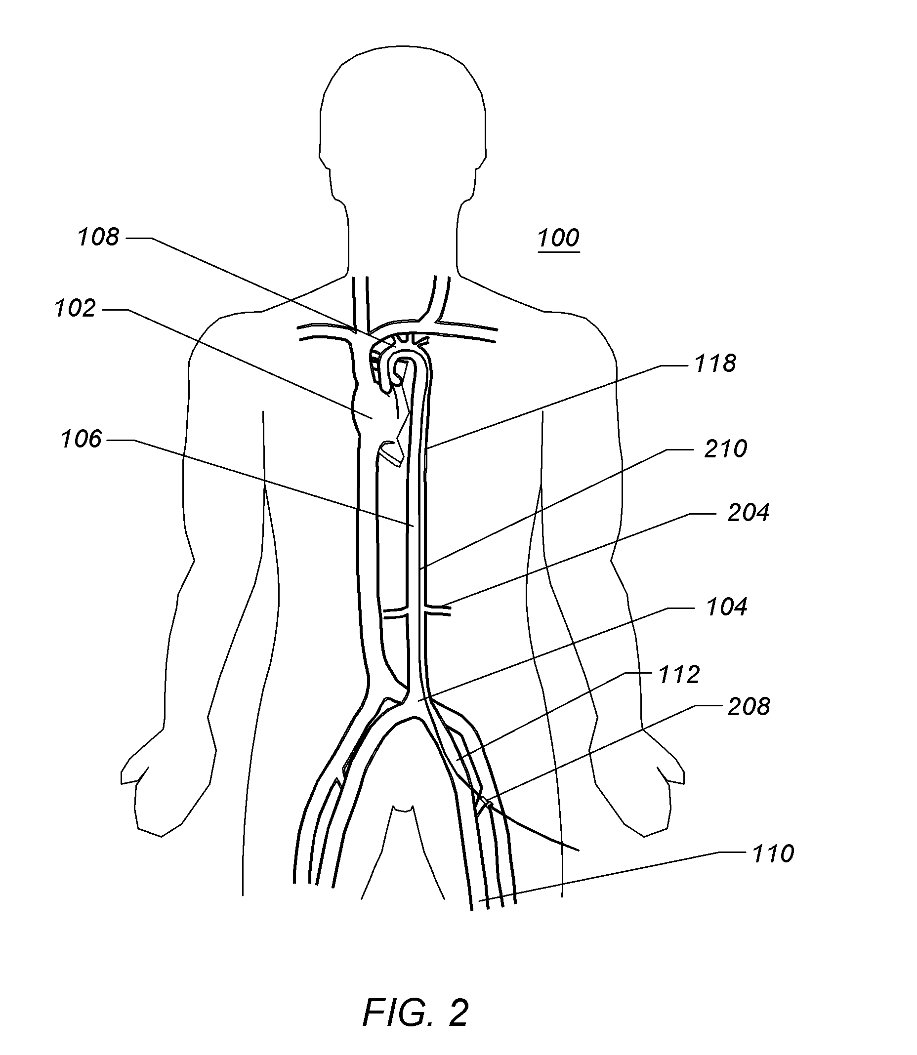 Expandable iliac sheath and method of use