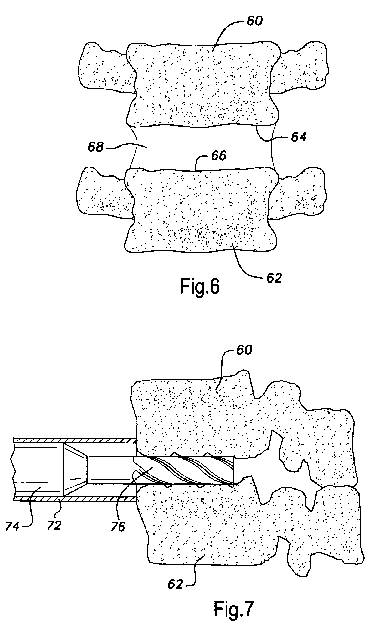 Arthrodesis of vertebral bodies