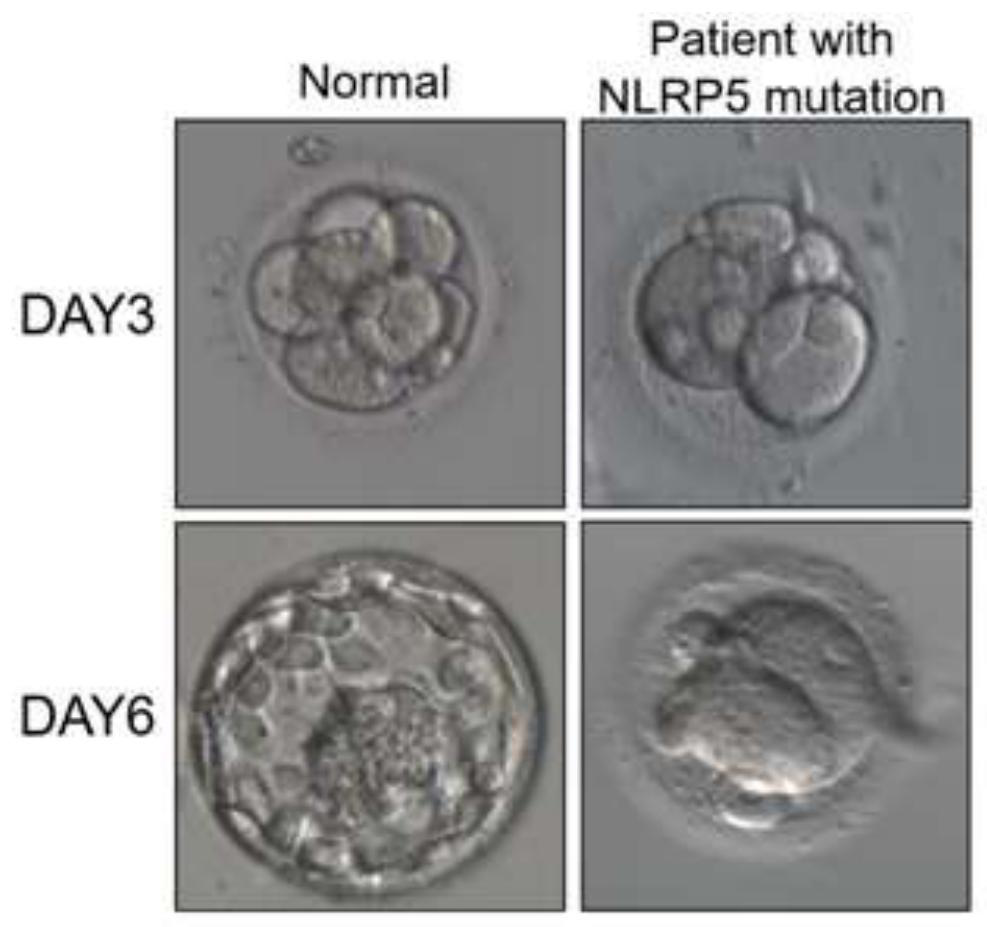 A pathogenic mutation of hereditary primary infertility and its detection reagent